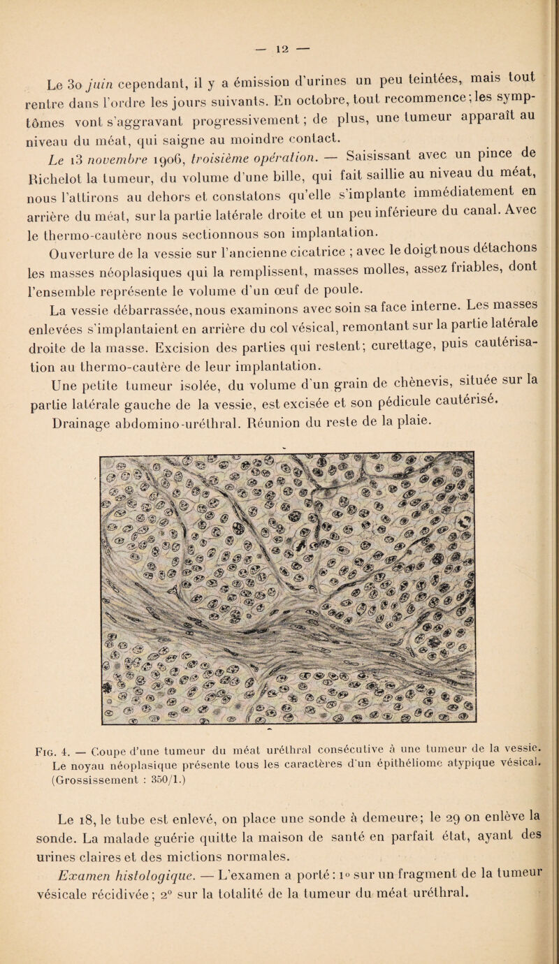 Le 3o juin cependant, il y a émission d’urines un peu teintées, mais tout rentre dans l’ordre les jours suivants. En octobre, tout recommence, les symp¬ tômes vont s’aggravant progressivement ; de plus, une tumeur appaiaît au niveau du méat, qui saigne au moindre contact. Le i3 novembre 1906, troisième opération. — Saisissant avec un pince de Richelot la tumeur, du volume d’une bille, qui fait saillie au niveau du méat, nous l’attirons au dehors et constatons qu’elle s’implante immédiatement en arrière du méat, sur la partie latérale droite et un peu inférieure du canal. Avec le thermo-cautère nous sectionnous son implantation. Ouverture de la vessie sur l’ancienne cicatrice ; avec le doigt nous détachons les masses néoplasiques qui la remplissent, masses molles, assez fiiables, dont l’ensemble représente le volume d’un œuf de poule. La vessie débarrassée, nous examinons avec soin sa face interne. Les masses enlevées s’implantaient en arrière du col vésical, remontant sur la partie latérale droite de la masse. Excision des parties qui restent; curettage, puis cautérisa¬ tion au thermo-cautère de leur implantation. Une petite tumeur isolée, du volume d’un grain de chènevis, située sur la partie latérale gauche de la vessie, est excisée et son pédicule cautérisé. Drainage abdomino-uréthral. Réunion du reste de la plaie. Fig. 4. — Coupe d’une tumeur du méat uréthral consécutive à une tumeur de la vessie. Le noyau néoplasique présente tous les caractères d un épithéliome atypique vésical. (Grossissement : 350/1.) Le 18, le tube est enlevé, on place une sonde à demeure; le 29 on enlève la sonde. La malade guérie quitte la maison de santé en parfait état, ayant des urines claires et des mictions normales. Examen histologique. — L’examen a porté : 1° sur un fragment de la tumeur vésicale récidivée; 20 sur la totalité de la tumeur du méat uréthral.