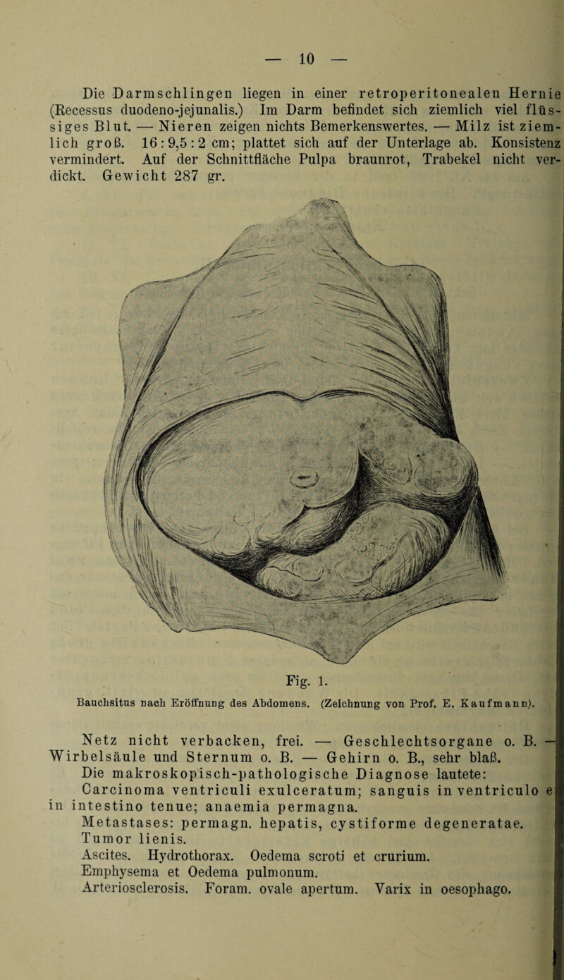 Die Darmschlingen liegen in einer retroperitonealen Hernie (Recessus duodeno-jejunalis.) Im Darm befindet sich ziemlich viel flüs¬ siges Blut. — Nieren zeigen nichts Bemerkenswertes. — Milz ist ziem¬ lich groß. 16:9,5:2 cm; plattet sich auf der Unterlage ab. Konsistenz vermindert. Auf der Schnittfläche Pulpa braunrot, Trabekel nicht ver¬ dickt. Gewicht 287 gr. Fig. 1. Bauchsitus nach Eröffnung des Abdomens. (Zeichnung von Prof. E. Kaufmann). Netz nicht verbacken, frei. — Geschlechtsorgane o. B. - Wirbelsäule und Sternum o. B. — Gehirn o. B., sehr blaß. Die makroskopisch-pathologische Diagnose lautete: Carcinoma ventriculi exulceratum; sanguis in ventriculo e in intestino tenue; anaemia permagna. Metastases: permagn. hepatis, cystiforme degeneratae. Tumor lienis. Ascites. Hydrothorax. Oedema scroti et crurium. Emphysema et Oedema pulmonum. Arteriosclerosis. Foram. ovale apertum. Varix in oesophago.