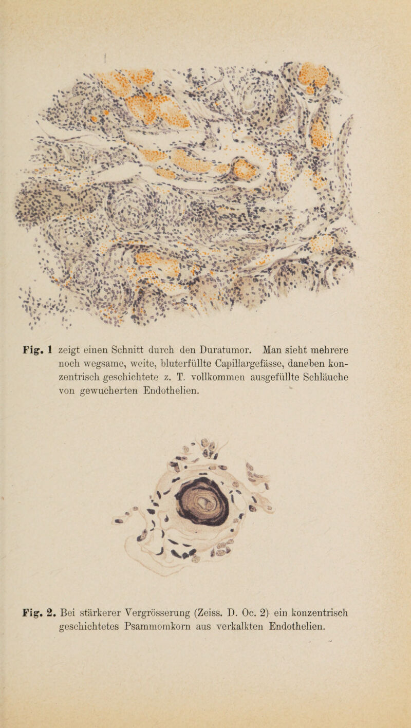 Fi g. 1 zeigt einen Schnitt durch den Duratumor. Man sieht mehrere noch wegsame, weite, bluterfüllte Capillargefässe, daneben kon¬ zentrisch geschichtete z. T. vollkommen ausgefüllte Schläuche von gewucherten Endothelien. Figr- 2. Bei stärkerer Vergrösserung (Zeiss. D. Oc. 2) ein konzentrisch geschichtetes Psammomkorn aus verkalkten Endothelien.