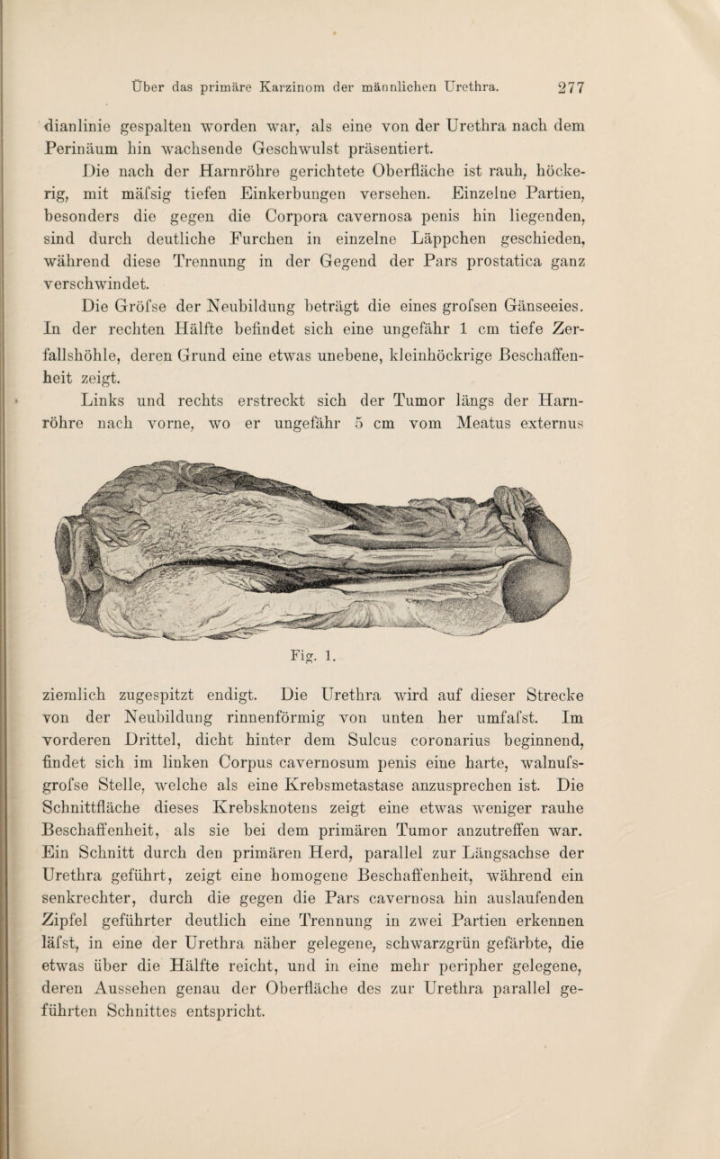 dianlinie gespalten worden war, als eine von der Urethra nach dem Perinäum hin wachsende Geschwulst präsentiert. Die nach der Harnröhre gerichtete Oberfläche ist rauh, höcke¬ rig, mit mäfsig tiefen Einkerbungen versehen. Einzelne Partien, besonders die gegen die Corpora cavernosa penis hin liegenden, sind durch deutliche Furchen in einzelne Läppchen geschieden, während diese Trennung in der Gegend der Pars prostatica ganz verschwindet. Die Gröfse der Neubildung beträgt die eines grofsen Gänseeies. In der rechten Hälfte befindet sich eine ungefähr 1 cm tiefe Zer¬ fallshöhle, deren Grund eine etwas unebene, kleinhöckrige Beschaffen¬ heit zeigt. Links und rechts erstreckt sich der Tumor längs der Harn¬ röhre nach vorne, wo er ungefähr 5 cm vom Meatus externus Fia. i. ziemlich zugespitzt endigt. Die Urethra wird auf dieser Strecke von der Neubildung rinnenförmig von unten her umfafst. Im vorderen Drittel, dicht hinter dem Sulcus coronarius beginnend, ■findet sich im linken Corpus cavernosum penis eine harte, walnufs- grofse Stelle, welche als eine Krebsmetastase anzusprechen ist. Die Schnittfläche dieses Krebsknotens zeigt eine etwas weniger rauhe Beschaffenheit, als sie bei dem primären Tumor anzutreffen war. Ein Schnitt durch den primären Herd, parallel zur Längsachse der Urethra geführt, zeigt eine homogene Beschaffenheit, während ein senkrechter, durch die gegen die Pars cavernosa hin auslaufenden Zipfel geführter deutlich eine Trennung in zwei Partien erkennen läfst, in eine der Urethra näher gelegene, schwarzgrün gefärbte, die etwas über die Hälfte reicht, und in eine mehr peripher gelegene, deren Aussehen genau der Oberfläche des zur Urethra parallel ge¬ führten Schnittes entspricht.