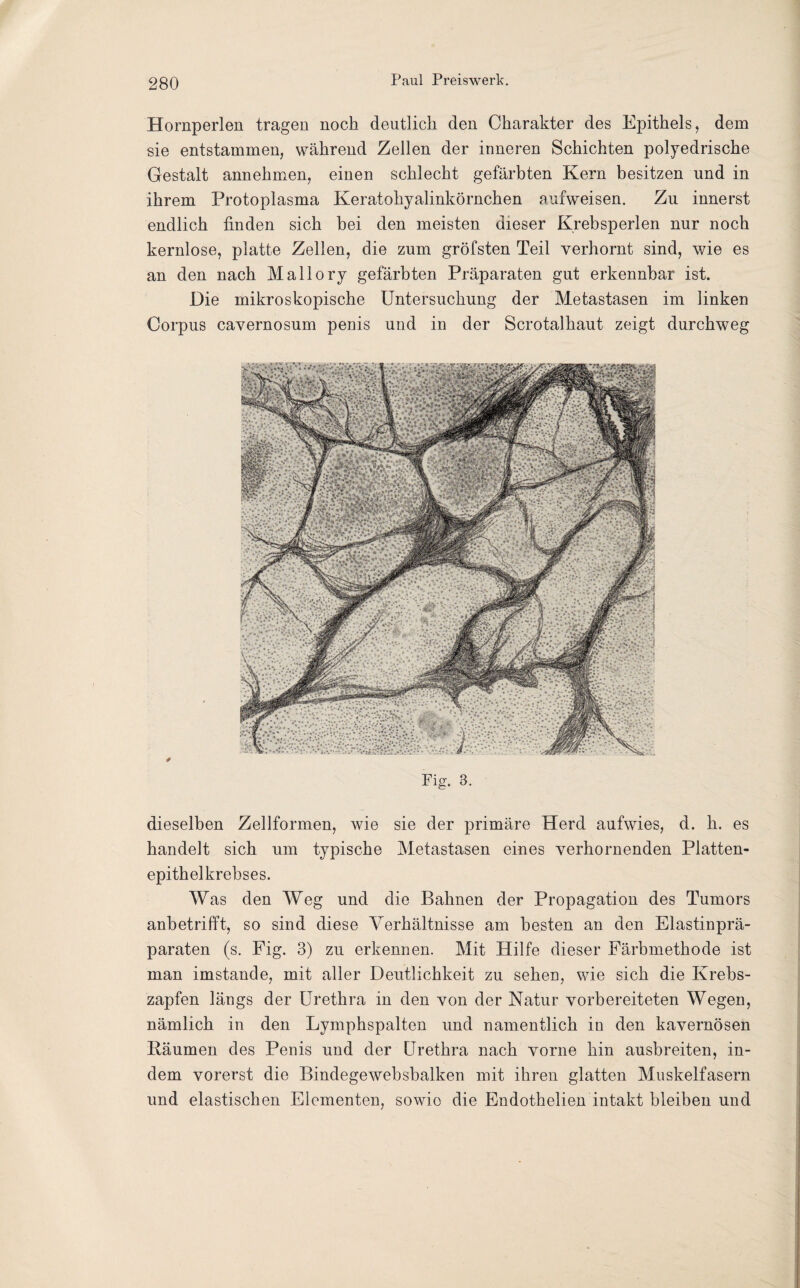 Hornperlen tragen noch deutlich den Charakter des Epithels, dem sie entstammen, während Zellen der inneren Schichten polyedrische Gestalt annehmen, einen schlecht gefärbten Kern besitzen und in ihrem Protoplasma Keratohyalinkörnchen aufweisen. Zu innerst endlich finden sich bei den meisten dieser Krebsperlen nur noch kernlose, platte Zellen, die zum gröfsten Teil verhornt sind, wie es an den nach Mallory gefärbten Präparaten gut erkennbar ist. Die mikroskopische Untersuchung der Metastasen im linken Corpus cavernosum penis und in der Scrotalhaut zeigt durchweg Fig. 3. dieselben Zellformen, wie sie der primäre Herd aufwies, d. h. es handelt sich um typische Metastasen eines verhornenden Platten¬ epithelkrebses. Was den Weg und die Bahnen der Propagation des Tumors anbetrifft, so sind diese Yerhältnisse am besten an den Elastinprä¬ paraten (s. Fig. 3) zu erkennen. Mit Hilfe dieser Färbmethode ist man imstande, mit aller Deutlichkeit zu sehen, wie sich die Krebs¬ zapfen längs der Urethra in den von der Natur vorbereiteten Wegen, nämlich in den Lymphspalten und namentlich in den kavernösen Bäumen des Penis und der Urethra nach vorne hin ausbreiten, in¬ dem vorerst die Bindegewebsbalken mit ihren glatten Muskelfasern und elastischen Elementen, sowie die Endothelien intakt bleiben und