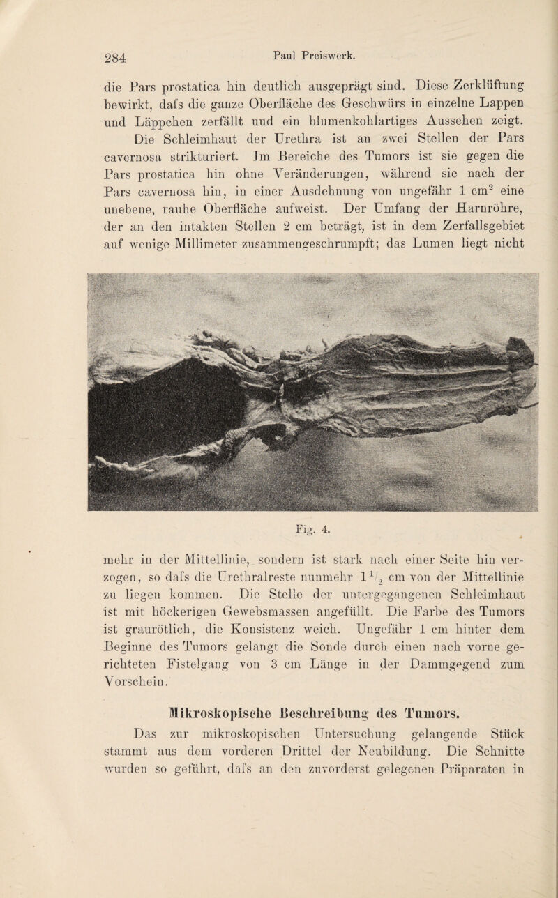 die Pars prostatica hin deutlich ausgeprägt sind. Diese Zerklüftung bewirkt, dafs die ganze Oberfläche des Geschwürs in einzelne Lappen und Läppchen zerfällt uud ein blumenkohlartiges Aussehen zeigt. Die Schleimhaut der Urethra ist an zwei Stellen der Pars cavernosa strikturiert. Tm Bereiche des Tumors ist sie gegen die Pars prostatica hin ohne Veränderungen, wrährend sie nach der Pars cavernosa hin, in einer Ausdehnung von ungefähr 1 cm2 eine unebene, rauhe Oberfläche aufweist. Der Umfang der Harnröhre, der an den intakten Stellen 2 cm beträgt, ist in dem Zerfallsgebiet auf wenige Millimeter zusammengeschrumpft; das Lumen liegt nicht mehr in der Mittellinie, sondern ist stark nach einer Seite hin ver¬ zogen, so dafs die Urethralreste nunmehr 11/2 cm von der Mittellinie zu liegen kommen. Die Stelle der untergegangenen Schleimhaut ist mit höckerigen Gewebsmassen angefüllt. Die Farbe des Tumors ist graurötlich, die Konsistenz weich. Ungefähr 1 cm hinter dem Beginne des Tumors gelangt die Sonde durch einen nach vorne ge¬ richteten Fistelgang von 3 cm Länge in der Dammgegend zum Vorschein. Mikroskopische Beschreibung des Tumors. Das zur mikroskopischen Untersuchung gelangende Stück stammt aus dem vorderen Drittel der Neubildung. Die Schnitte wurden so geführt, dafs an den zuvorderst gelegenen Präparaten in