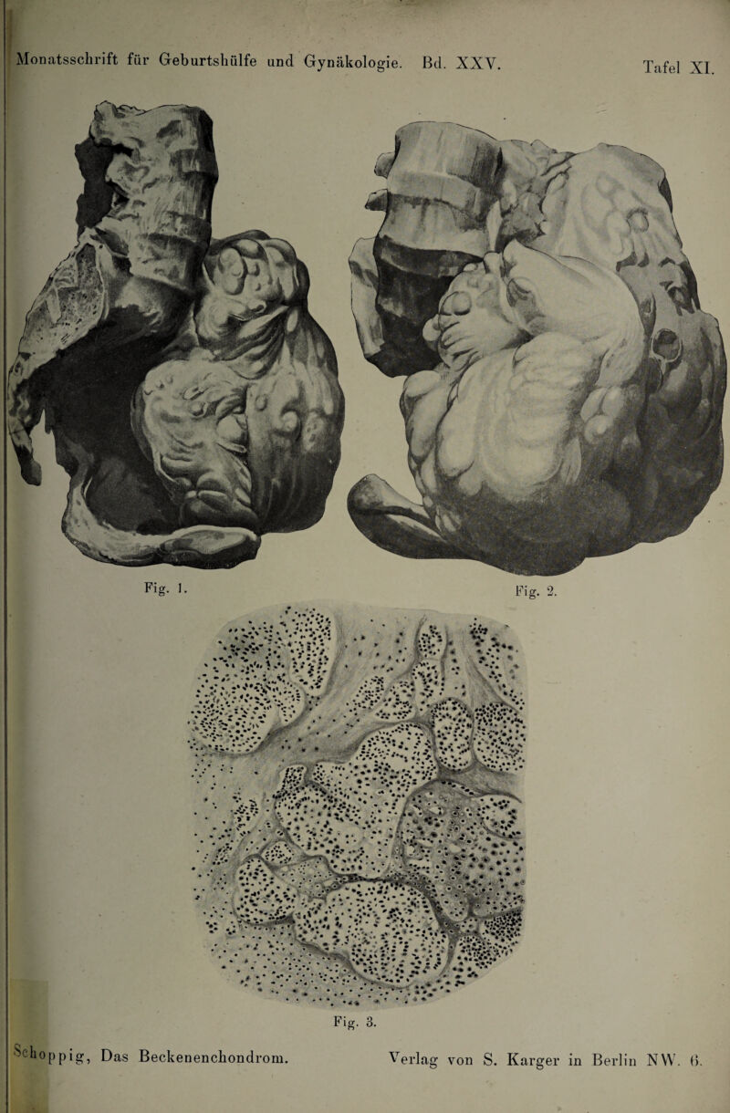 Monatsschrift für Geburtshülfe und Gynäkologie. Bd. XXV. Tafel XI. Sei i°ppig, Das Beckenenchondrom. Verlag von S. Karger in Berlin NW. 6.