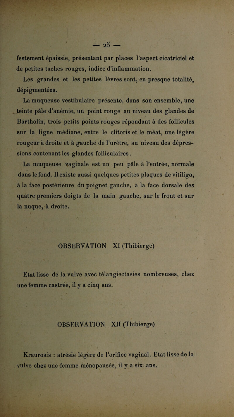 festement épaissie, présentant par places l’aspect cicatriciel et de petites taches rouges, indice d’inflammation. Les grandes et les petites lèvres sont, en presque totalité, dépigmentées. La muqueuse vestibulaire présente, dans son ensemble, une teinte pâle d’anémie, un point rouge au niveau des glandes de Bartholin, trois petits points rouges répondant à des follicules sur la ligne médiane, entre le clitoris et le méat, une légère rougeur à droite et à gauche de l’urètre, au niveau des dépres¬ sions contenant les glandes folliculaires. La muqueuse vaginale est un peu pâle à l’entrée, normale dans le fond. 11 existe aussi quelques petites plaques devitiligo, à la face postérieure du poignet gauche, à la face dorsale des quatre premiers doigts de la main gauche, sur le front et sur la nuque, à droite. OBSERVATION XI (Thibierge) Etat lisse de la vulve avec télangiectasies nombreuses, chez une femme castrée, il y a cinq ans. OBSERVATION XII (Thibierge) Kraurosis : atrésie légère de l’orifice vaginal. Etat lisse de la * • vulve chez une femme ménopausée, il y a six ans.