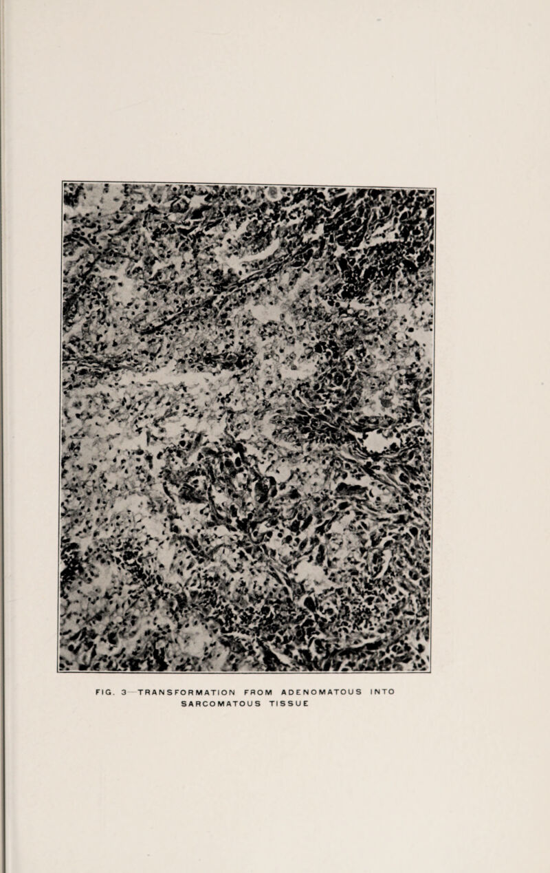 wm FIG. 3 TRANSFORMATION FROM ADENOMATOUS INTO SARCOMATOUS TISSUE