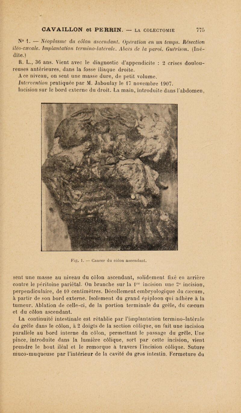 N° 1. — Néoplasme du côlon ascendant. Opération en un temps. Résection ilco-cæcale. Implantation termino-latérale. Abcès de la paroi. Guérison. (Iné¬ dite.) H. L., 36 ans. \ient avec le diagnostic d’appendicite : 2 crises doulou¬ reuses antérieures, dans la fosse iliaque droite. Ace niveau, on sent une masse dure, de petit volume. Intervention pratiquée par M. Jaboulay le 17 novembre 1907. Incision sur le bord externe du droit. La main, introduite dans l'abdomen, Fig. 1. — Cancer du côlon ascendant. sent une masse au niveau du côlon ascendant, solidement fixé en arrière contre le péritoine pariétal. On branche sur la lr0 incision une 2° incision, perpendiculaire, de 10 centimètres. Décollement embryologique du cæcum, à partir de son bord externe. Isolement du grand épiploon qui adhère à la tumeur. Ablation de celle-ci, de la portion terminale du grêle, du cæcum et du côlon ascendant. La continuité intestinale est rétablie par l’implantation termino-latérale du grêle dans le côlon, à 2 doigts de la section colique, on fait une incision parallèle au bord interne dn côlon, permettant le passage du grêle. Une pince, introduite dans la lumière côlique, sort par cette incision, vient prendre le bout iléal et le remorque à travers l’incision côlique. Suture muco-muqueuse par l’intérieur de la cavité du gros intestin. Fermeture du