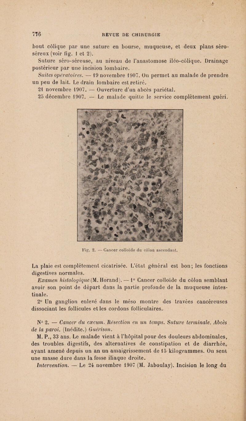 bout colique par une suture en bourse, muqueuse, et deux plans séro- séreux (voir fig. 1 et 2). Suture séro-séreuse, au niveau de l’anastomose iléo-côlique. Drainage postérieur par une incision lombaire. Suites opératoires. — 19 novembre 1907. On permet au malade de prendre un peu de lait. Le drain lombaire est retiré. 21 novembre 1907. — Ouverture d’un abcès pariétal. 25 décembre 1907. — Le malade quitte le service complètement guéri. Fig. 2. — Cancer colloïde du côlou ascendant. La plaie est complètement cicatrisée. L’état général est bon; les fonctions digestives normales. Examen histologique (M. Horand). — 1° Cancer colloïde du côlon semblant avoir son point de départ dans la partie profonde de la muqueuse intes¬ tinale. 2° Un ganglion enlevé dans le méso montre des travées cancéreuses dissociant les follicules et les cordons folliculaires. N° 2. — Cancer du cæcum. Résection en un temps. Suture terminale. Abcès de la paroi. (Inédite.) Guérison. M. P., 33 ans. Le malade vient à l’hôpital pour des douleurs abdominales, des troubles digestifs, des alternatives de constipation et de diarrhée, ayant amené depuis un an un amaigrissement de 15 kilogrammes. On sent une masse dure dans la fosse iliaque droite. Intervention. — Le 24 novembre 1907 (M. Jaboulay). Incision le long du
