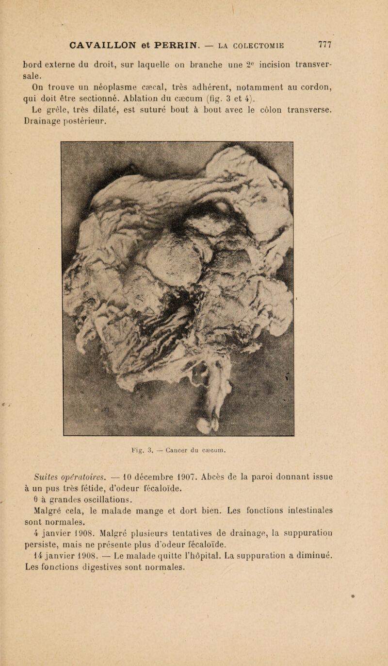 bord externe du droit, sur laquelle on branche une 2e incision transver¬ sale. On trouve un néoplasme cæcal, très adhérent, notamment au cordon, qui doit être sectionné. Ablation du cæcum (fig. 3 et 4). Le grêle, très dilaté, est suturé bout à bout avec le côlon transverse. Drainage postérieur. Fig. 3. — Cancer du cæcum. Suites opératoires. — 10 décembre 1907. Abcès de la paroi donnant issue à un pus très fétide, d’odeur fécaloïde. 6 à grandes oscillations. Malgré cela, le malade mange et dort bien. Les fonctions intestinales sont normales. 4 janvier 1908. Malgré plusieurs tentatives de drainage, la suppuration persiste, mais ne présente plus d’odeur fécaloïde. 14 janvier 1908. — Le malade quitte l’hôpital. La suppuration a diminué. Les fonctions digestives sont normales.