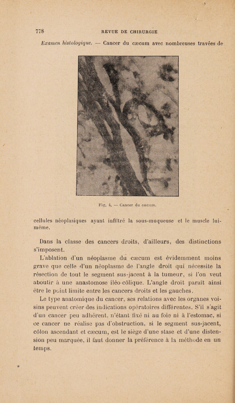 Fig. 4. — Cancer du cæcum. Examen histologique. — Cancer du cæcum avec nombreuses travées de cellules néoplasiques ayant infiltré la sous-muqueuse et le muscle lui- même. Dans la classe des cancers droits, d’ailleurs, des distinctions s’imposent. L’ablation d’un néoplasme du cæcum est évidemment moins grave que celle d’un néoplasme de l’angle droit qui nécessite la résection de tout le segment sus-jacent à la tumeur, si l’on veut aboutir à une anastomose iléo-colique. L’angle droit paraît ainsi être le point limite entre les cancers droits et les gauches. Le type anatomique du cancer, ses relations avec les organes voi¬ sins peuvent créer des indications opératoires différentes. S’il s’agit d’un cancer peu adhérent, n’étant fixé ni au foie ni à l’estomac, si ce cancer ne réalise pas d’obstruction, si le segment sus-jacent, côlon ascendant et cæcum, est le siège d’une stase et d’une disten¬ sion peu marquée, il faut donner la préférence à la méthode en un temps.