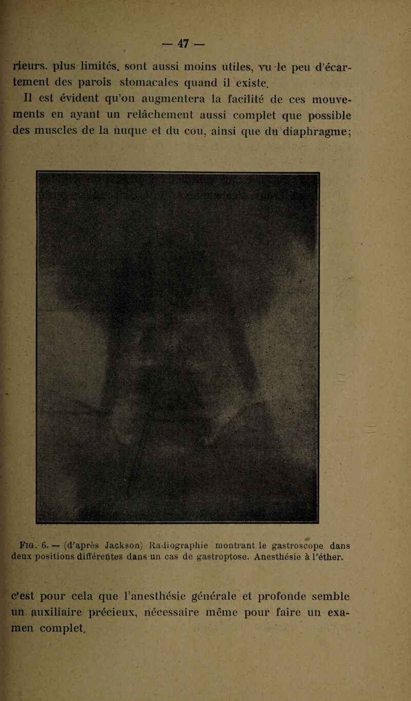 rieurs, plus limités, sont aussi moins utiles, vu le peu d’écar¬ tement des parois stomacales quand il existe. Il est évident qu’on augmentera la facilité de ces mouve¬ ments en ayant un relâchement aussi complet que possible des muscles de la nuque et du cou, ainsi que du diaphragme; Fia. 6. — (d'après Jackson) Radiographie montrant le gastroscope dans deux positions différeûtes dans un cas de gastroptose. Anesthésie à l'éther. c’est pour cela que l’anestliésie générale et profonde semble un auxiliaire précieux, nécessaire même pour faire un exa¬ men complet.