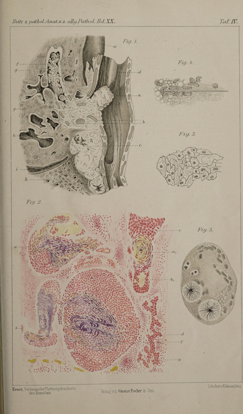 Beiti: z.pathol.An at.u.2. ally.Pathol. Bel. XX. Taf.IV. * • •» 1 > vSgM$J Uiw;ifA; Ern-st, VerhonienderPIattenepithelkrel^: des Bronchus. vi: GnsfavPischer in Jena. LilhAnst v.KWesserJena.