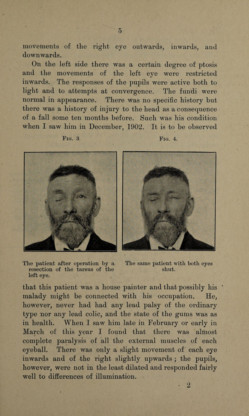 movements of the right eye outwards, inwards, and downwards. On the left side there was a certain degree of ptosis and the movements of the left eye were restricted inwards. The responses of the pupils were active both to light and to attempts at convergence. The fundi were normal in appearance. There was no specific history but there was a history of injury to the head as a consequence of a fall some ten months before. Such was his condition when I saw him in December, 1902. It is to be observed Fig. 3. Fig. 4. The patient after operation by a The same patient with both eyes resection of the tarsus of the shut, left eye. that this patient was a house painter and that possibly his ’ malady might be connected with his occupation. He, however, never had had any lead palsy of the ordinary type nor any lead colic, and the state of the gums was as in health. When I saw him late in February or early in March of this year I found that there was almost complete paralysis of all the external muscles of each eyeball. There was only a slight movement of each eye inwards and of the right slightly upwards ; the pupils, however, were not in the least dilated and responded fairly well to differences of illumination. 2