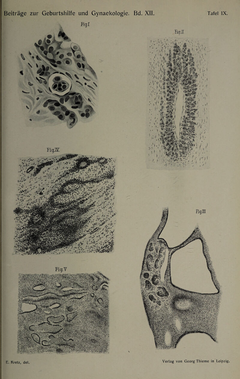 Bd. XII. Tafel IX. Eq: IT v -m ■ ': “V V> , t )• * 155g > :< // v'^ViVfüV '• < , • * f \\ *% | f . ,S * i» * ,jw®’ j‘ • H ' •: «fc i 1 ‘ ■ •• 4 *k \&‘4i . I> ■ i, K ^.5 i '■ ■{«'Ä1, Vf--*-- ■ ■■ v '££*• . ; • . ' ;V'. ■ ' Beiträge zur Geburtshilfe und Gynaekologie. E. Kretz, del Verlag von Georg Thieme in Leipzig,
