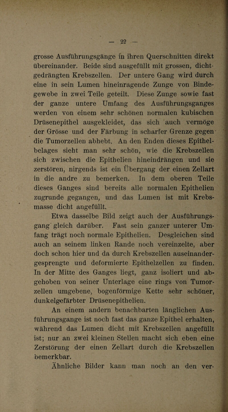 grosse Ausführungsgänge in ihren Querschnitten direkt übereinander. Beide sind ausgefüllt mit grossen, dicht¬ gedrängten Krebszellen. Der untere Gang wird durch eine in sein Lumen hineinragende Zunge von Binde¬ gewebe in zwei Teile geteilt. Diese Zunge sowie fast der ganze untere Umfang des Ausführungsganges werden von einem sehr schönen normalen kubischen Drüsenepithel ausgekleidet, das sich auch vermöge der Grösse und der Färbung in scharfer Grenze gegen- die Tumorzellen abhebt. An den Enden dieses Epithel¬ belages sieht man sehr schön, wie die Krebszellen sich zwischen die Epithelien hineindrängen und sie • • _ zerstören, nirgends ist ein Übergang der einen Zellart in die andre zu bemerken. In dem oberen Teile dieses Ganges sind bereits alle normalen Epithelien zugrunde gegangen, und das Lumen ist mit Krebs¬ masse dicht angefüllt. Etwa dasselbe Bild zeigt auch der Ausführungs¬ gang gleich darüber. Fast sein ganzer unterer Um¬ fang trägt noch normale Epithelien. Desgleichen sind auch an seinem linken Rande noch vereinzelte, aber doch schon hier und da durch Krebszellen auseinander¬ gesprengte und deformierte Epithelzellen zu finden. In der Mitte des Ganges liegt, ganz isoliert und ab¬ gehoben von seiner Unterlage eine rings von Tumor¬ zellen umgebene, bogenförmige Kette sehr schöner, dunkelgefärbter Drüsenepithelien. An einem andern benachbarten länglichen Aus¬ führungsgange ist noch fast das ganze Epithel erhalten, während das Lumen dicht mit Krebszellen angefüllt ist; nur an zwei kleinen Stellen macht sich eben eine Zerstörung der einen Zellart durch die Krebszellen bemerkbar. Ähnliche Bilder kann man noch an den ver-