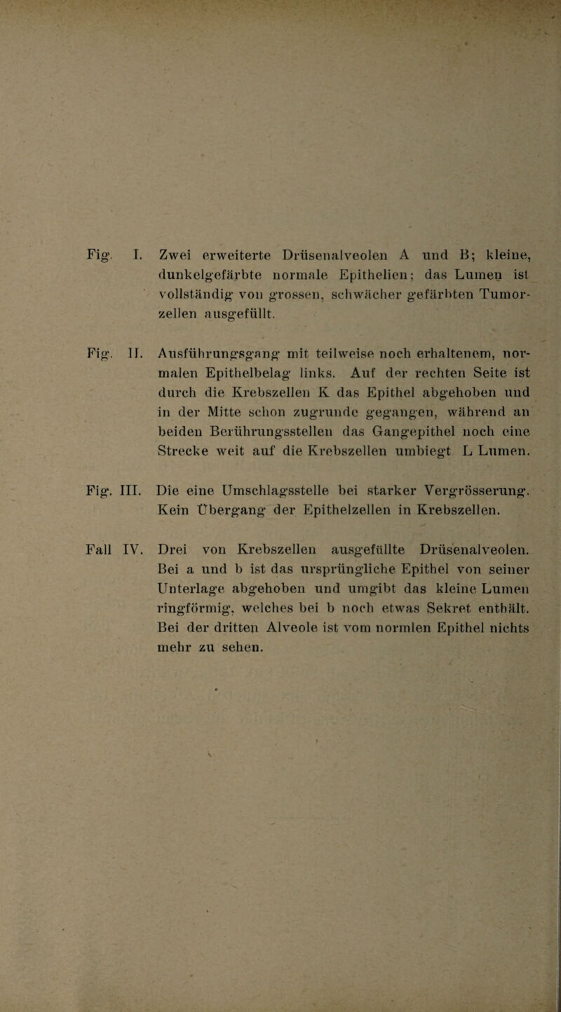 Fig\ I. Zwei erweiterte Drüsenalveolen A und B; kleine, dunkelgefärbte normale Epithelien; das Lumen ist vollständig“ von grossen, schwächer gefärbten Tumor¬ zellen ausgefüllt. Fig. II. Ausführungsgang mit teilweise noch erhaltenem, nor¬ malen Epithelbelag links. Auf der rechten Seite ist durch die Krebszellen K das Epithel abgehoben und in der Mitte schon zugrunde gegangen, während an beiden Berührungsstellen das Gangepithel noch eine Strecke weit auf die Krebszellen umbiegt L Lumen. Fig. III. Die eine Umschlagsstelle bei starker Vergrösserung. Kein Übergang der Epithelzellen in Krebszellen. Fall IV. Drei von Krebszellen ausgefüllte Drüsenalveolen. Bei a und b ist das ursprüngliche Epithel von seiner Unterlage abgehoben und umgibt das kleine Lumen ringförmig, welches bei b noch etwas Sekret enthält. Bei der dritten Alveole ist vom normten Epithel nichts mehr zu sehen.