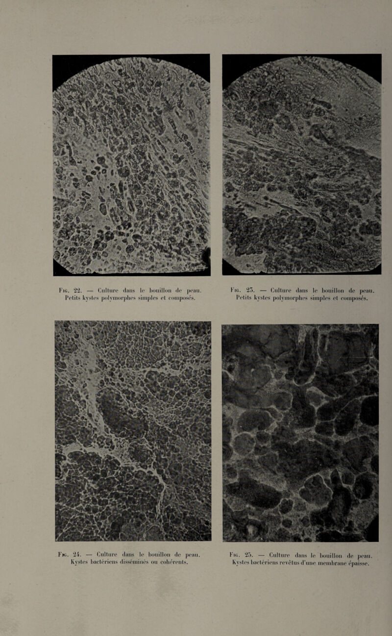 1*33 « i .,V iJJttS HElf Fig. 22. — Culture dans le bouillon de peau. Petits kystes polymorphes simples et composés. Fig. 25. — Culture dans le bouillon de peau. Petits kystes polymorphes simples et composés. F»g. 24. — Culture dans le bouillon de peau. Kystes bactériens disséminés ou cohérents. I'ig. 25. — Culture dans le bouillon de peau. Kystes bactériens revêtus d’une membrane épaisse.