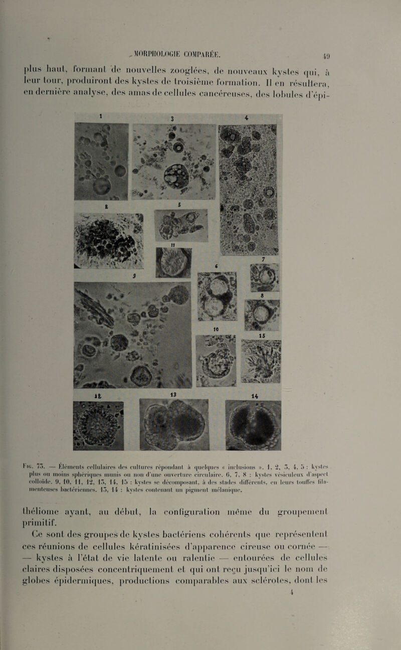 plus haut, formant de nouvelles zooglées, de nouveaux kystes qui, à leur tour, produiront des kystes de troisième formation. Il en résultera, en dernière analyse, des amas de cellules cancéreuses, des lobules d epi- l'io. 75. — Éléments cellulaires des cultures répondant à quelques « inclusions ». 1, 2, 3, i, 5: kystes plus ou moins sphériques munis ou non d’une ouverture circulaire. (3, 7. N : kystes vésiculeux d'aspect colloïde. 9, 10, 11, 12, 13, 14, 15 : kystes se décomposant, à des stades dillércnls, en leurs loull'es lila- mentcuscs bactériennes. 13, 14 : kystes contenant un pigment mélanique. théliome ayant, au début, la configuration même du groupement primitif. Ce sont des groupes de kystes bactériens cohérents (pic représentent ces réunions de cellules kératinisées d’apparence cireuse ou cornée — — kystes à l’état de vie latente ou ralentie — entourées de cellules claires disposées concentriquement et qui ont reçu jusqu’ici le nom de globes épidermiques, productions comparables aux sclérotcs, dont les