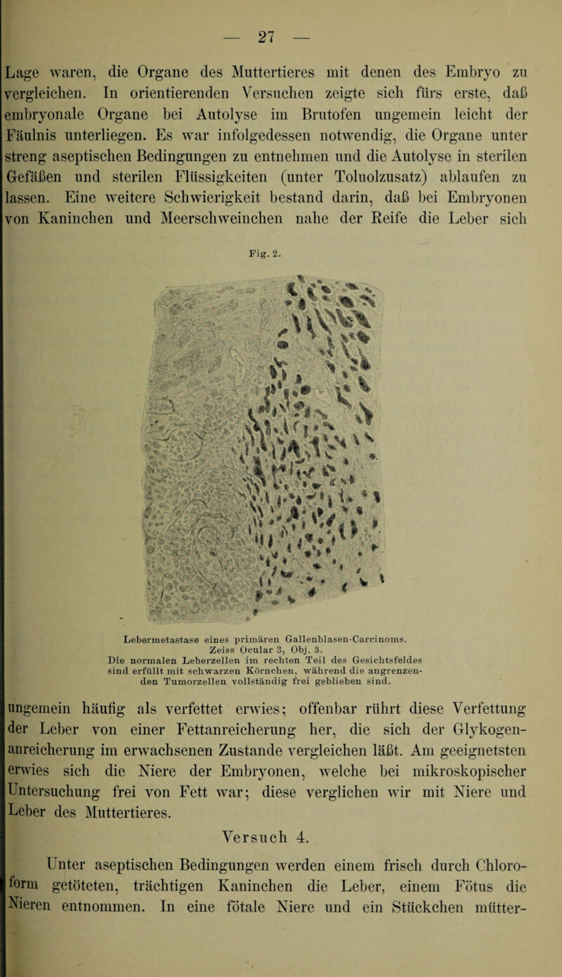 Lage waren, die Organe des Muttertieres mit denen des Embryo zu vergleichen. In orientierenden Versuchen zeigte sich fürs erste, daß embryonale Organe bei Autolyse im Brutofen ungemein leicht der Fäulnis unterliegen. Es war infolgedessen notwendig, die Organe unter streng aseptischen Bedingungen zu entnehmen und die Autolyse in sterilen Gefäßen und sterilen Flüssigkeiten (unter Toluolzusatz) ablaufen zu lassen. Eine weitere Schwierigkeit bestand darin, daß bei Embryonen von Kaninchen und Meerschweinchen nahe der Reife die Leber sich Fig.2. Lebermetastase eines primären Gallenblasen-Carcinoms. Zeiss Ocular 3, Obj. 3. Die normalen Leberzellen im rechten Teil des Gesichtsfeldes sind erfüllt mit schwarzen Körnchen, während die angrenzen¬ den Tumorzellen vollständig frei geblieben sind. ungemein häutig als verfettet erwies; offenbar rührt diese Verfettung der Leber von einer Fettanreicherung her, die sich der Glykogen¬ anreicherung im erwachsenen Zustande vergleichen läßt. Am geeignetsten erwies sich die Niere der Embryonen, welche bei mikroskopischer Untersuchung frei von Fett war; diese verglichen wir mit Niere und Leber des Muttertieres. Versuch 4. Unter aseptischen Bedingungen werden einem frisch durch Chloro¬ form getöteten, trächtigen Kaninchen die Leber, einem Fötus die Nieren entnommen. In eine fötale Niere und ein Stückchen mtttter- H '