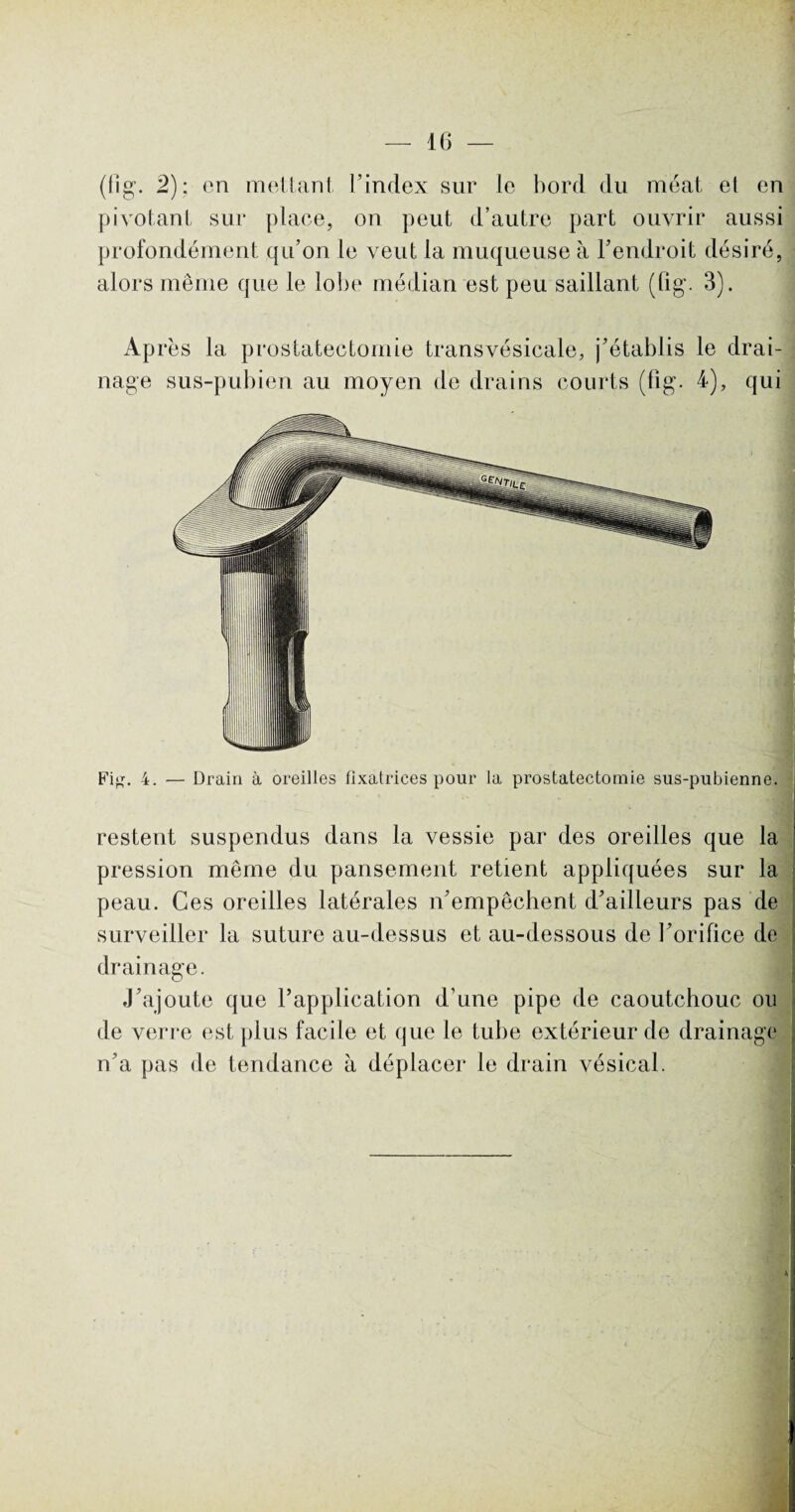 (fi g. 2): en mettant l’index sur le bord du méat et en pivotant sur place, on peut d’autre part ouvrir aussi profondément qu’on le veut la muqueuse à l’endroit désiré, alors même que le lobe médian est peu saillant (lig. 3). Après la prostatectomie transvésicale, j’établis le drai¬ nage sus-pubien au moyen de drains courts (fîg. 4), qui restent suspendus dans la vessie par des oreilles que la pression même du pansement retient appliquées sur la peau. Ces oreilles latérales n’empêchent d’ailleurs pas de surveiller la suture au-dessus et au-dessous de l’orifice de drainage. J’ajoute que l’application d’une pipe de caoutchouc ou de verre est plus facile et que le tube extérieur de drainage n’a pas de tendance à déplacer le drain vésical.