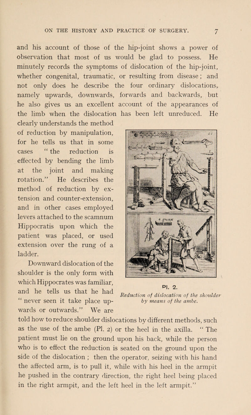 and his account of those of the hip-joint shows a power of observation that most of us would be glad to possess. He minutely records the symptoms of dislocation of the hip-joint, whether congenital, traumatic, or resulting from disease; and not only does he describe the four ordinary dislocations, namely upwards, downwards, forwards and backwards, but he also gives us an excellent account of the appearances of the limb when the dislocation has been left unreduced. He clearly understands the method of reduction by manipulation, for he tells us that in some cases “ the reduction is effected by bending the limb at the joint and making rotation.” He describes the method of reduction by ex¬ tension and counter-extension, and in other cases employed levers attached to the scamnum Hippocratis upon which the patient was placed, or used extension over the rung of a ladder. Downward dislocation of the shoulder is the only form with which Hippocrates was familiar, and he tells us that he had „ ^ r Reduction of dislocation of the shoulder “ never seen it take place up- by means of the ambe. wards or outwards.” We are told how to reduce shoulder dislocations by different methods, such as the use of the ambe (PI. 2) or the heel in the axilla. ‘‘ The patient must lie on the ground upon his back, while the person who is to effect the reduction is seated on the ground upon the side of the dislocation ; then the operator, seizing with his hand the affected arm, is to pull it, while with his heel in the armpit he pushed in the contrary direction, the right heel being placed in the right armpit, and the left heel in the left armpit.”