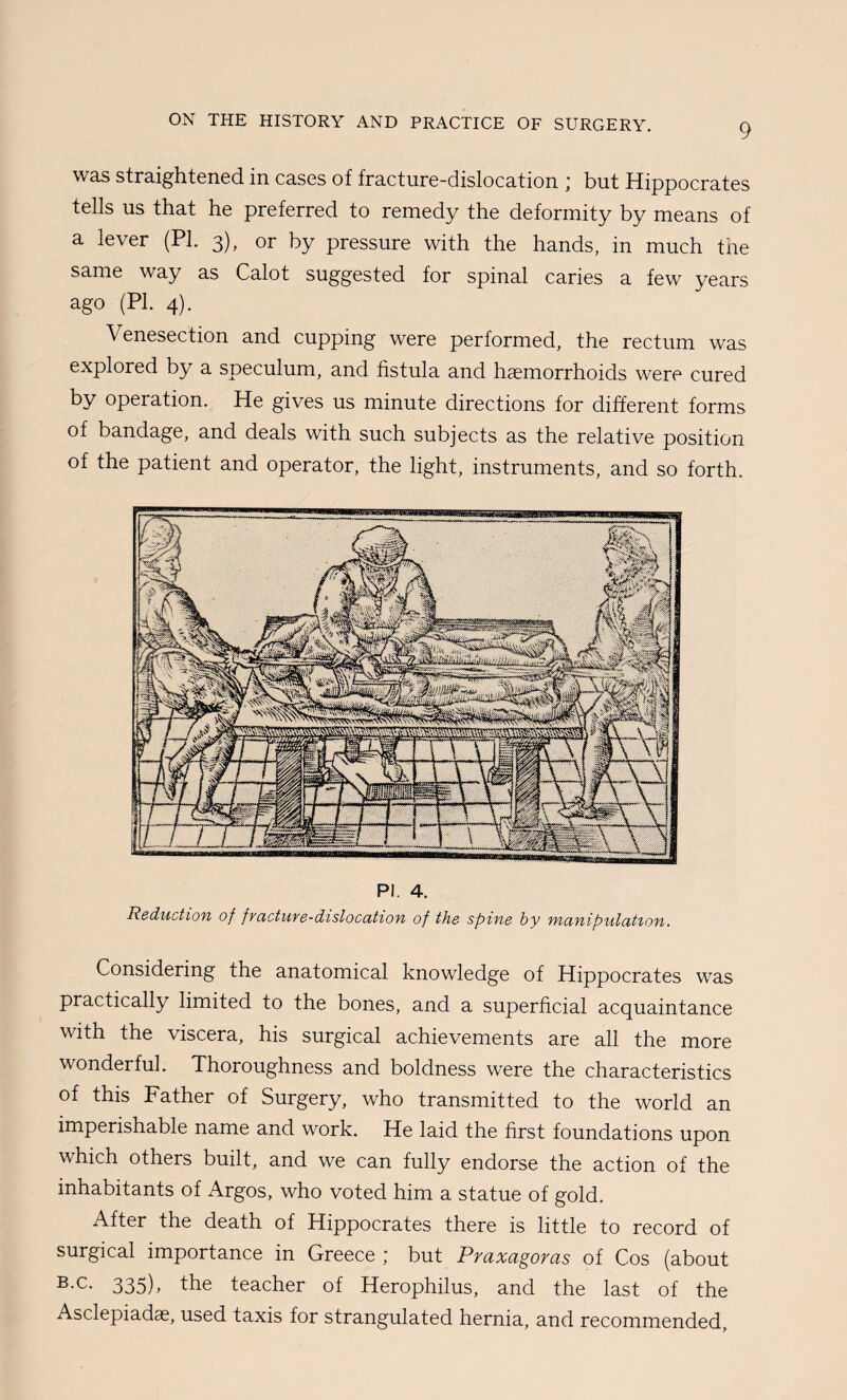 WAS straightened in cases of fracture-dislocation ] but Hippocrates tells us that he preferred to remedy the deformity by means of a lever (PI. 3), or by pressure with the hands, in much the same way as Calot suggested for spinal caries a few years ago (PI. 4). Venesection and cupping were performed, the rectum was explored by a speculum, and fistula and haemorrhoids were cured by operation. He gives us minute directions for different forms of bandage, and deals with such subjects as the relative position of the patient and operator, the light, instruments, and so forth. PI. 4. Reduction of fracture-dislocation of the spine by manipulation. Considering the anatomical knowledge of Hippocrates was practically limited to the bones, and a superficial acquaintance with the viscera, his surgical achievements are all the more wonderful. Thoroughness and boldness were the characteristics of this Father of Surgery, who transmitted to the world an imperishable name and work. He laid the first foundations upon which others built, and we can fully endorse the action of the inhabitants of Argos, who voted him a statue of gold. After the death of Hippocrates there is little to record of surgical importance in Greece ; but Praxagoras of Cos (about 335), the teacher of Herophilus, and the last of the Asclepiadae, used taxis for strangulated hernia, and recommended.