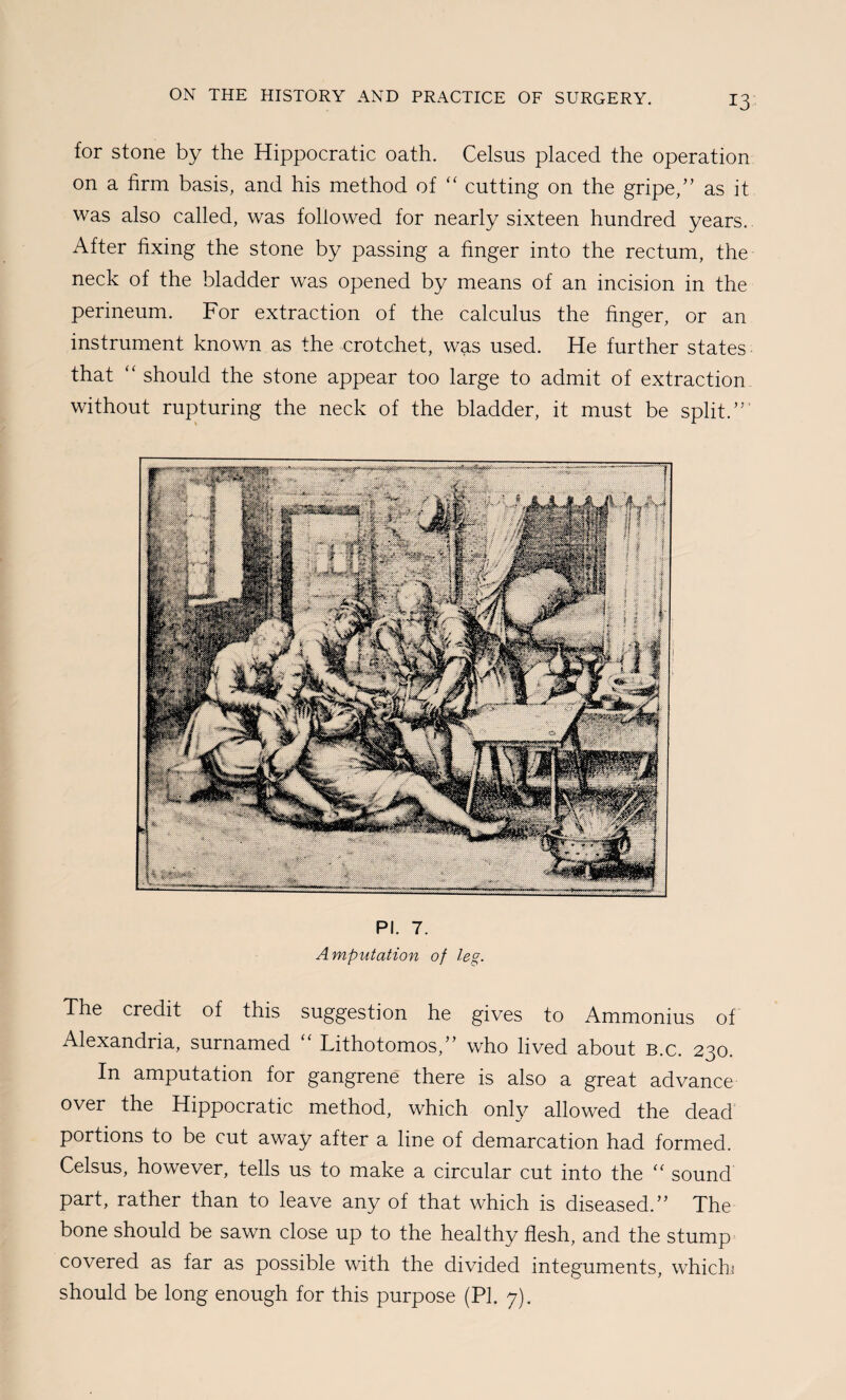 for stone by the Hippocratic oath. Celsus placed the operation on a firm basis, and his method of ‘‘ cutting on the gripe,” as it was also called, was followed for nearly sixteen hundred years. After fixing the stone by passing a finger into the rectum, the neck of the bladder was opened by means of an incision in the perineum. For extraction of the calculus the finger, or an instrument known as the crotchet, was used. He further states that “ should the stone appear too large to admit of extraction without rupturing the neck of the bladder, it must be split.”’ PI. 7. Amputation of leg. The credit of this suggestion he gives to Ammonius of Alexandria, surnamed Lithotomos,” who lived about b.c. 230. In amputation for gangrene there is also a great advance over the Hippocratic method, which only allowed the dead portions to be cut away after a line of demarcation had formed. Celsus, however, tells us to make a circular cut into the sound part, rather than to leave any of that which is diseased.” The bone should be sawn close up to the healthy flesh, and the stump' covered as far as possible with the divided integuments, whichj should be long enough for this purpose (PI. 7).