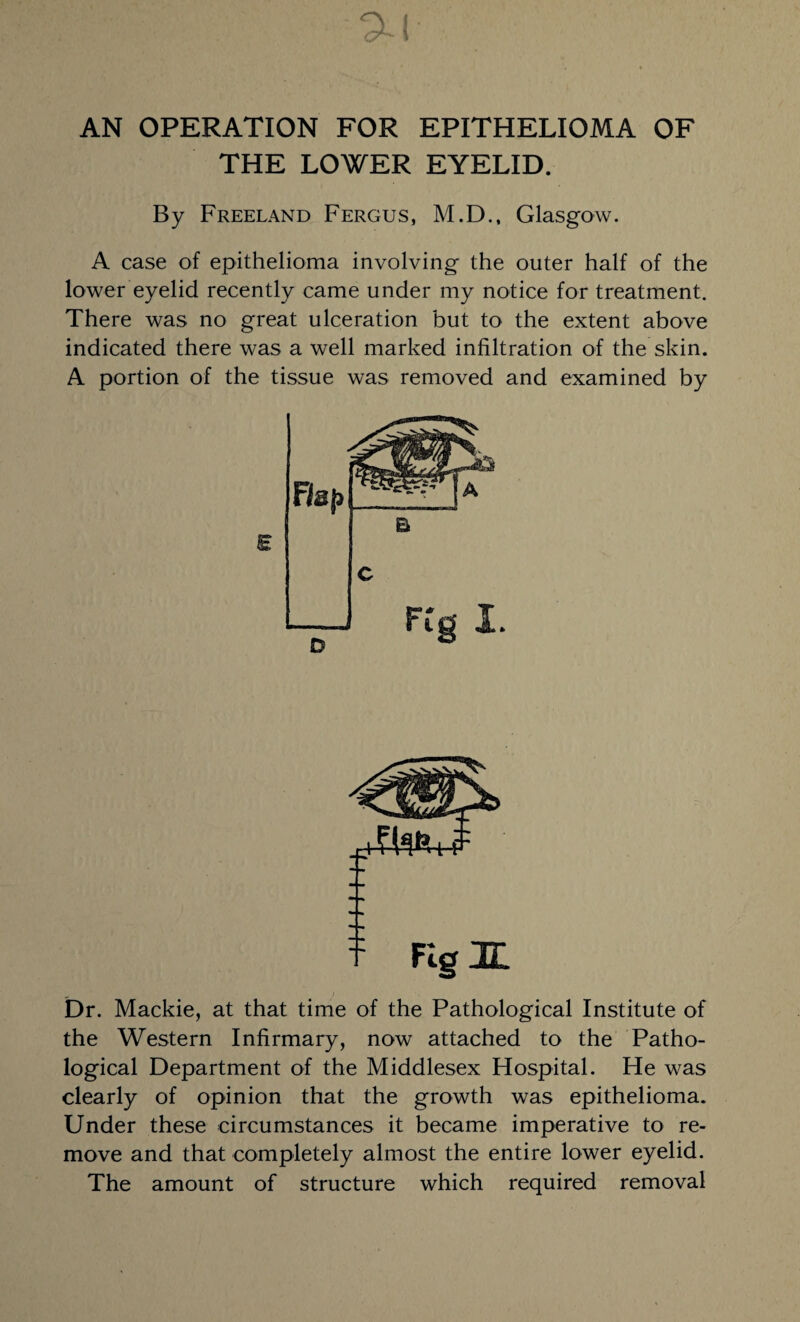 Gr* i AN OPERATION FOR EPITHELIOMA OF THE LOWER EYELID. By Freeland Fergus, M.D., Glasgow. A case of epithelioma involving the outer half of the lower eyelid recently came under my notice for treatment. There was no great ulceration but to the extent above indicated there was a well marked infiltration of the skin. A portion of the tissue was removed and examined by Dr. Mackie, at that time of the Pathological Institute of the Western Infirmary, now attached to the Patho¬ logical Department of the Middlesex Hospital. He was clearly of opinion that the growth was epithelioma. Under these circumstances it became imperative to re¬ move and that completely almost the entire lower eyelid. The amount of structure which required removal