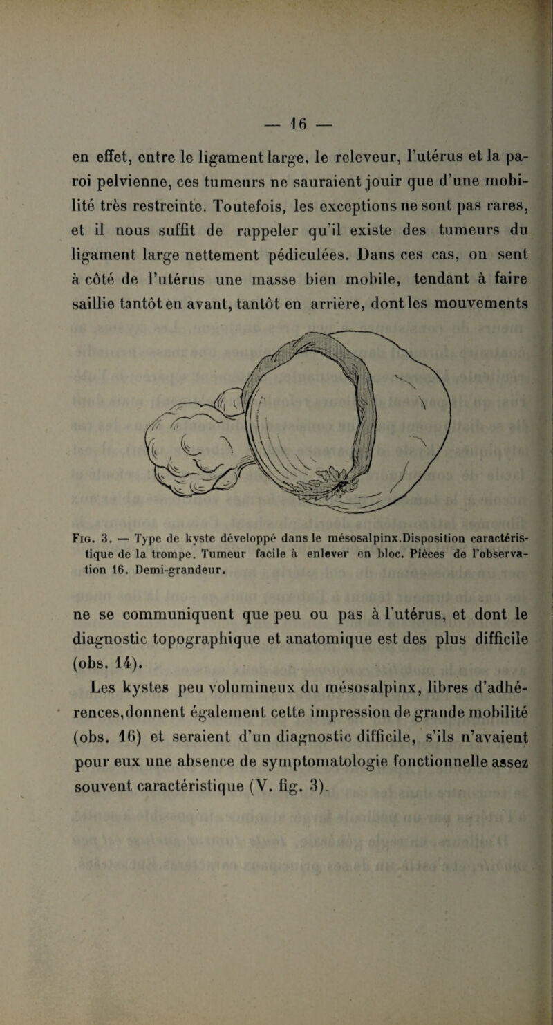en effet, entre le ligament large, le releveur, l’utérus et la pa¬ roi pelvienne, ces tumeurs ne sauraient jouir que d’une mobi¬ lité très restreinte. Toutefois, les exceptions ne sont pas rares, et il nous suffît de rappeler qu'il existe des tumeurs du ligament large nettement pédiculées. Dans ces cas, on sent à côté de l’utérus une masse bien mobile, tendant à faire saillie tantôt en avant, tantôt en arrière, dont les mouvements Fig. 3. — Type de kyste développé dans le mésosalpinx.Disposition caractéris¬ tique de la trompe. Tumeur facile à enlever en bloc. Pièces de l’observa¬ tion 16. Demi-grandeur. ne se communiquent que peu ou pas à l’utérus, et dont le diagnostic topographique et anatomique est des plus difficile (obs. 14). Les kystes peu volumineux du mésosalpinx, libres d’adhé¬ rences, donnent également cette impression de grande mobilité (obs. 16) et seraient d’un diagnostic difficile, s’ils n’avaient pour eux une absence de symptomatologie fonctionnelle assez souvent caractéristique (Y. fig. 3).