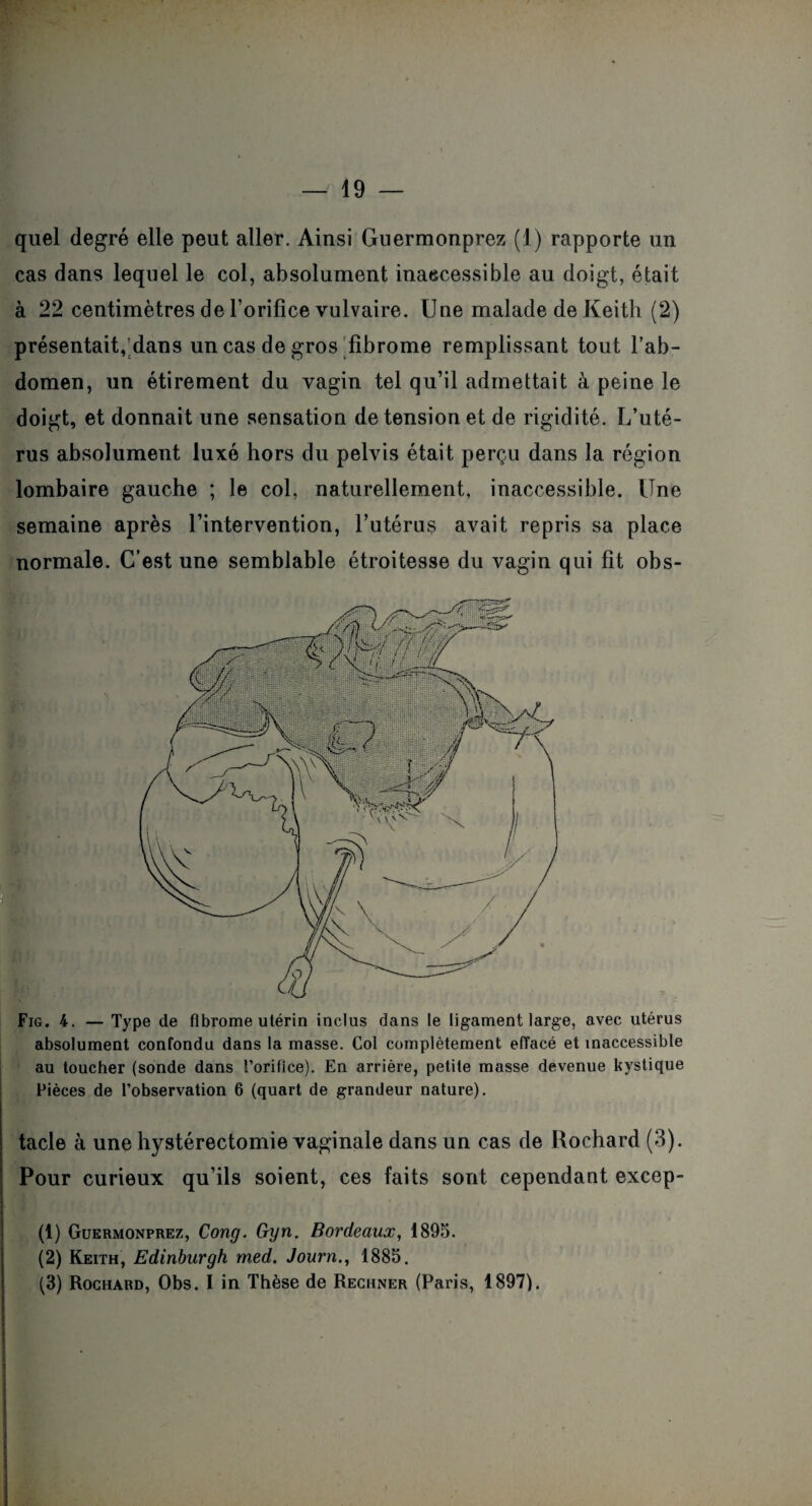 quel degré elle peut aller. Ainsi Guermonprez (1) rapporte un cas dans lequel le col, absolument inaccessible au doigt, était à 22 centimètres de l’orifice vulvaire. Une malade de Keith (2) présentait, dans un cas de gros fibrome remplissant tout l’ab¬ domen, un étirement du vagin tel qu’il admettait à peine le doigt, et donnait une sensation de tension et de rigidité. L’uté¬ rus absolument luxé hors du pelvis était perçu dans la région lombaire gauche ; le col, naturellement, inaccessible. Une semaine après l’intervention, l’utérus avait repris sa place normale. C’est une semblable étroitesse du vagin qui fit obs- Fig. 4. — Type de fibrome utérin inclus dans le ligament large, avec utérus absolument confondu dans la masse. Col complètement effacé et inaccessible au toucher (sonde dans l’orifice). En arrière, petite masse devenue kystique Pièces de l’observation 6 (quart de grandeur nature). tacle à une hystérectomie vaginale dans un cas de Rochard (3). Pour curieux qu’ils soient, ces faits sont cependant excep- (1) Guermonprez, Cong. Gyn. Bordeaux, 1895. (2) Keith, Edinburgh med. Journ., 1885. (3) Rochard, Obs. I in Thèse de Rechner (Paris, 1897).
