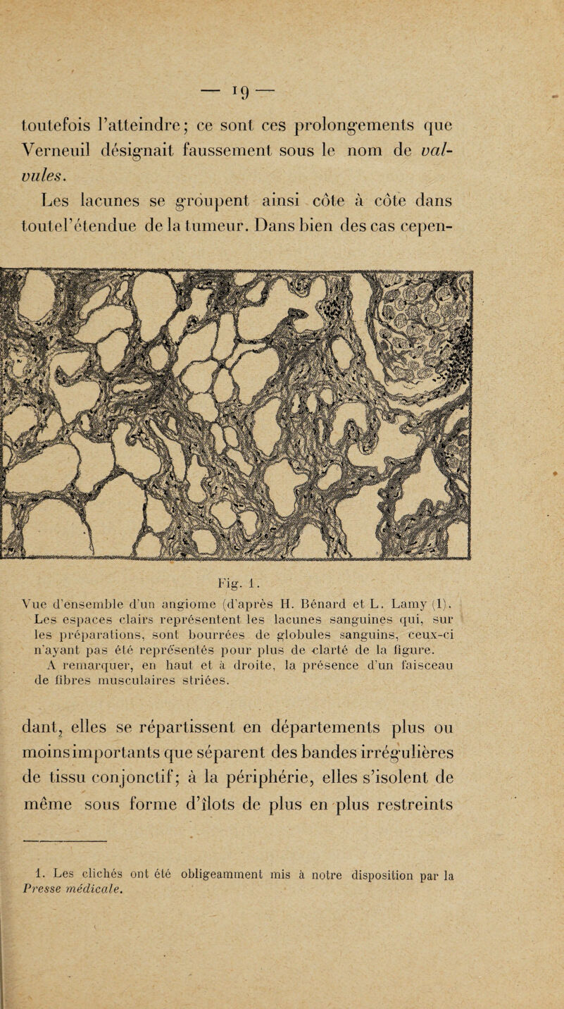 — J9 toutefois l’atteindre; ce sont ces prolongements que Verneuil désignait faussement sous le nom de val¬ vules. Les lacunes se groupent ainsi côte à côte dans toutel’étendue de la tumeur. Dans bien des cas cepen- Fig. 1. Vue d’ensemble d’un angiome (d’après H. Bénard et L. Lamy (1). Les espaces clairs représentent les lacunes sanguines qui, sur les préparations, sont bourrées de globules sanguins, ceux-ci n’ayant pas été représentés pour plus de clarté de la figure. A remarquer, en haut et à droite, la présence d’un faisceau de fibres musculaires striées. dant, elles se répartissent en départements plus ou moins importants que séparent des bandes irrégulières de tissu conjonctif; à la périphérie, elles s’isolent de meme sous forme d’îlots de plus en plus restreints 1. Les clichés ont été obligeamment mis à notre disposition par la Presse médicale.