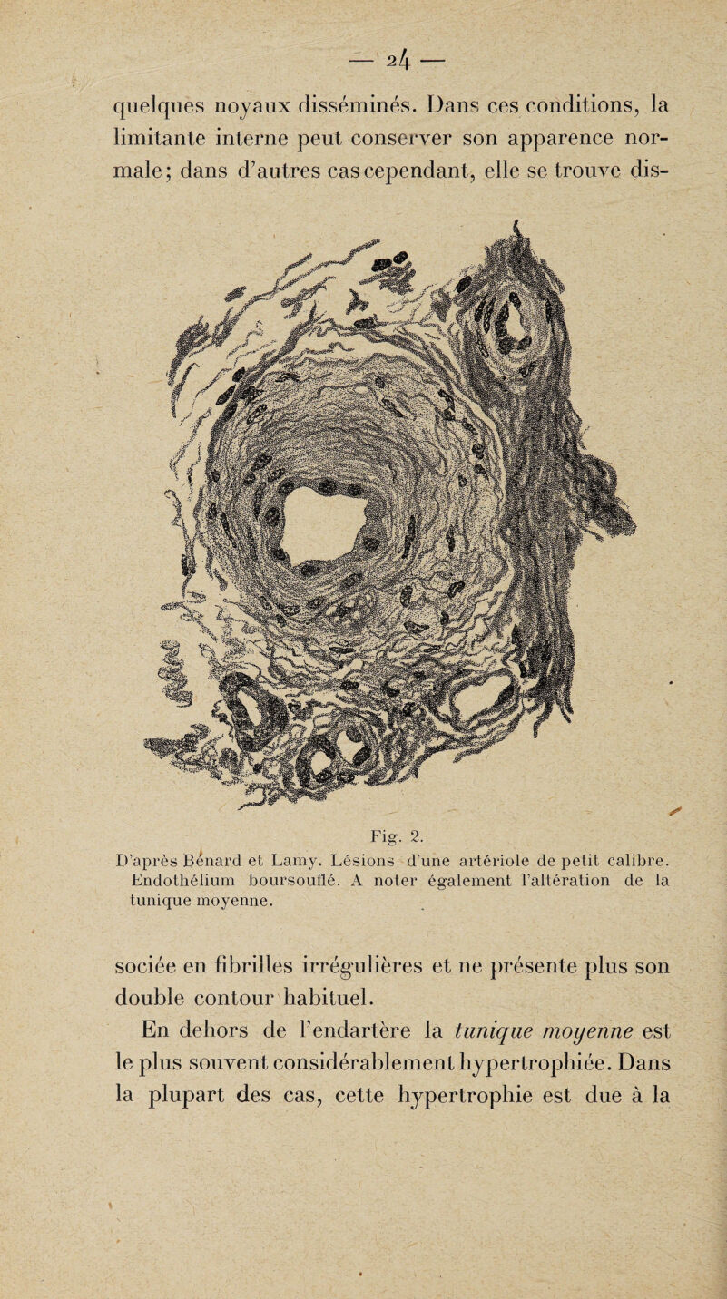 M quelques noyaux disséminés. Dans ces conditions, la limitante interne peut conserver son apparence nor¬ male; dans d’autres cas cependant, elle se trouve dis- Fig. 2. D’après Bénard et Lamy. Lésions d’une artériole de petit calibre. Endothélium boursouflé. A noter également l’altération de la tunique moyenne. sociée en fibrilles irrégulières et ne présente plus son double contour habituel. En dehors de Fendartère la tunique moyenne est le plus souvent considérablement hypertrophiée. Dans la plupart des cas, cette hypertrophie est due à la