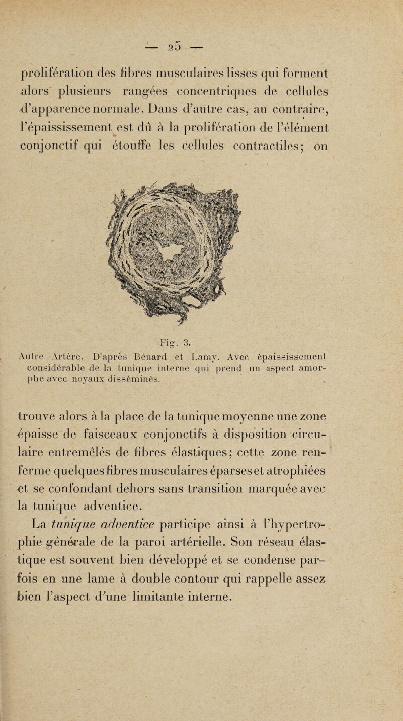 prolifération des fibres musculaires lisses qui forment alors plusieurs rangées concentriques de cellules d’apparence normale. Dans d’autre cas, au contraire, 4 l’épaississement est dû à la prolifération de l’élément conjonctif qui étouffe les cellules contractiles; on Fig. 3. Autre Artère. D’après Bénard et Lamy. Avec épaississement considérable de la tunique interne qui prend un aspect amor¬ phe avec noyaux disséminés. trouve alors à la place de la tunique moyenne une zone épaisse de faisceaux conjonctifs à disposition circu¬ laire entremêlés de fibres élastiques; cette zone ren¬ ferme quelques fibres musculaires éparses et atrophiées et se confondant dehors sans transition marquée avec la tunique adventice. La tunique adventice participe ainsi à l’hypertro¬ phie générale de la paroi artérielle. Son réseau élas¬ tique est souvent bien développé et se condense par¬ fois en une lame à double contour qui rappelle assez bien l’aspect d’une limitante interne.