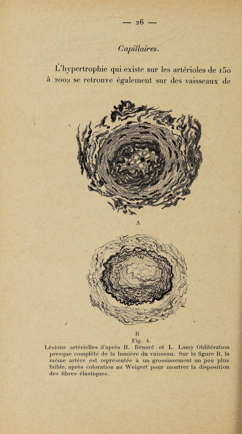 Capillaires. * L’hypertrophie qui existe sur les artérioles de i5o à 200;/ se retrouve également sur des vaisseaux de A Lésions artérielles d’après H. Bénard et L. Lamy Oblitération presque complète de la lumière du vaisseau. Sur la figure B, la même artère est représentée à un grossissement un peu plus faible, après coloration au Weigert pour montrer la disposition des fibres élastiques.