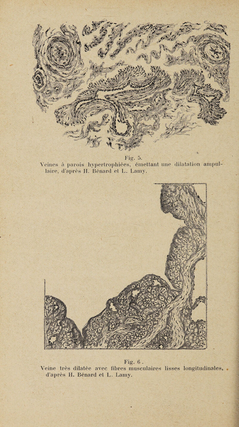 mêïâêâ \ Fig. 5. Veines à parois hypertrophiées, émettant une dilatation annui¬ taire, d’après H. Bénard et L. Lamy. Fig. 6 . Veine très dilatée avec fibres musculaires lisses d’après H. Bénard et L. Lamy. longitudinales y