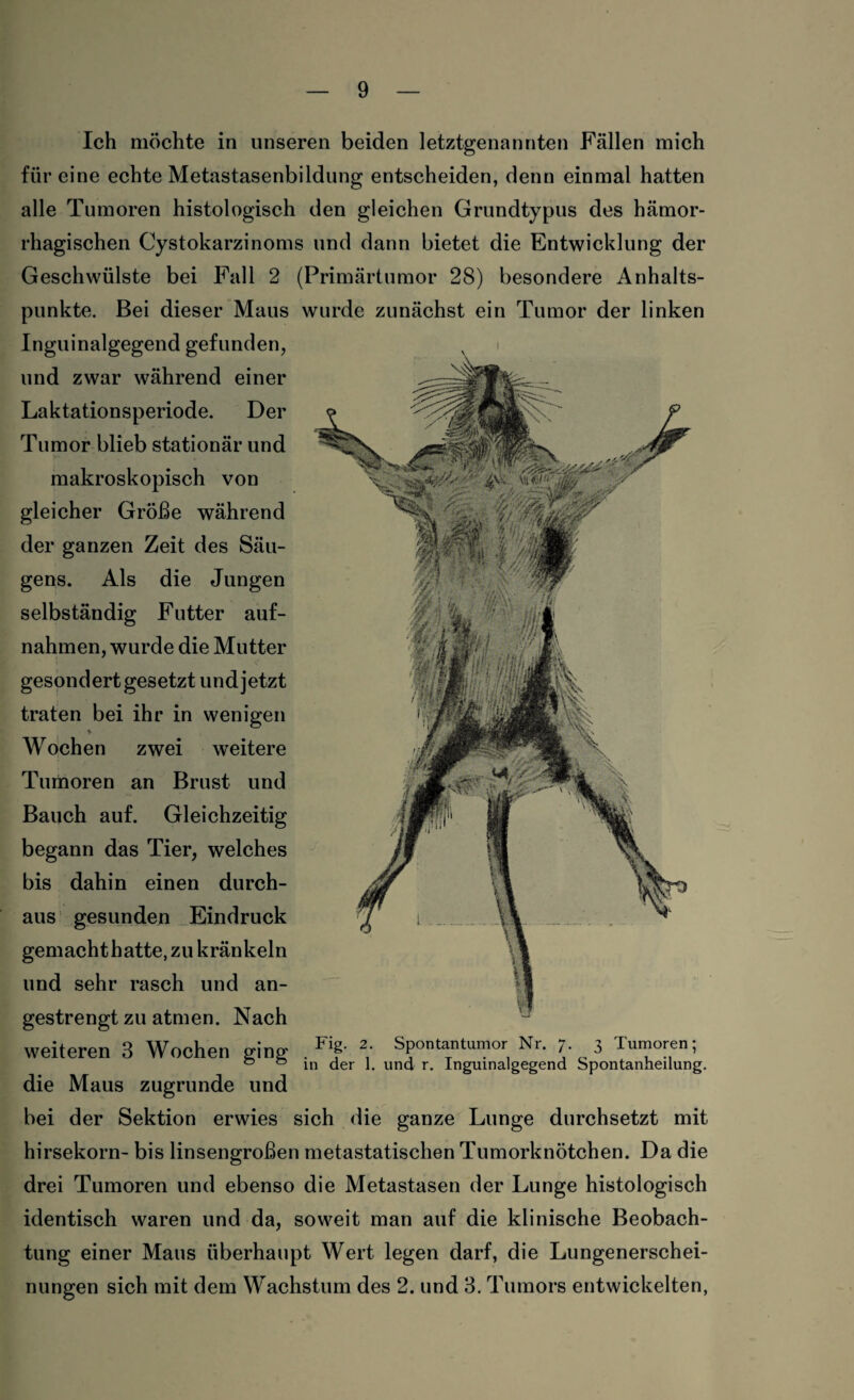 Ich möchte in unseren beiden letztgenannten Fällen mich für eine echte Metastasenbildung entscheiden, denn einmal hatten alle Tumoren histologisch den gleichen Grundtypus des hämor¬ rhagischen Cystokarzinoms und dann bietet die Entwicklung der Geschwülste bei Fall 2 (Primärtumor 28) besondere Anhalts¬ punkte. Bei dieser Maus wurde zunächst ein Tumor der linken Inguinalgegend gefunden, und zwar während einer Laktationsperiode. Der Tumor blieb stationär und makroskopisch von gleicher Größe während der ganzen Zeit des Säu- gens. Als die Jungen selbständig Futter auf- nahmen, wurde die Mutter gesondert gesetzt und jetzt traten bei ihr in wenigen Wochen zwei weitere Tumoren an Brust und Bauch auf. Gleichzeitig begann das Tier, welches bis dahin einen durch¬ aus gesunden Eindruck gemacht hatte, zu kränkeln und sehr rasch und an¬ gestrengt zu atmen. Nach weiteren 3 Wochen ging . Fif 2,' Spontantumor Nr. 7. 3 Tumoren; 0 0 in der 1. und r. Inguinalgegend Spontanheilung. die Maus zugrunde und bei der Sektion erwies sich die ganze Lunge durchsetzt mit hirsekorn- bis linsengroßen metastatischen Tumorknötchen. Da die drei Tumoren und ebenso die Metastasen der Lunge histologisch identisch waren und da, soweit man auf die klinische Beobach¬ tung einer Maus überhaupt Wert legen darf, die Lungenerschei¬ nungen sich mit dem Wachstum des 2. und 3. Tumors entwickelten,