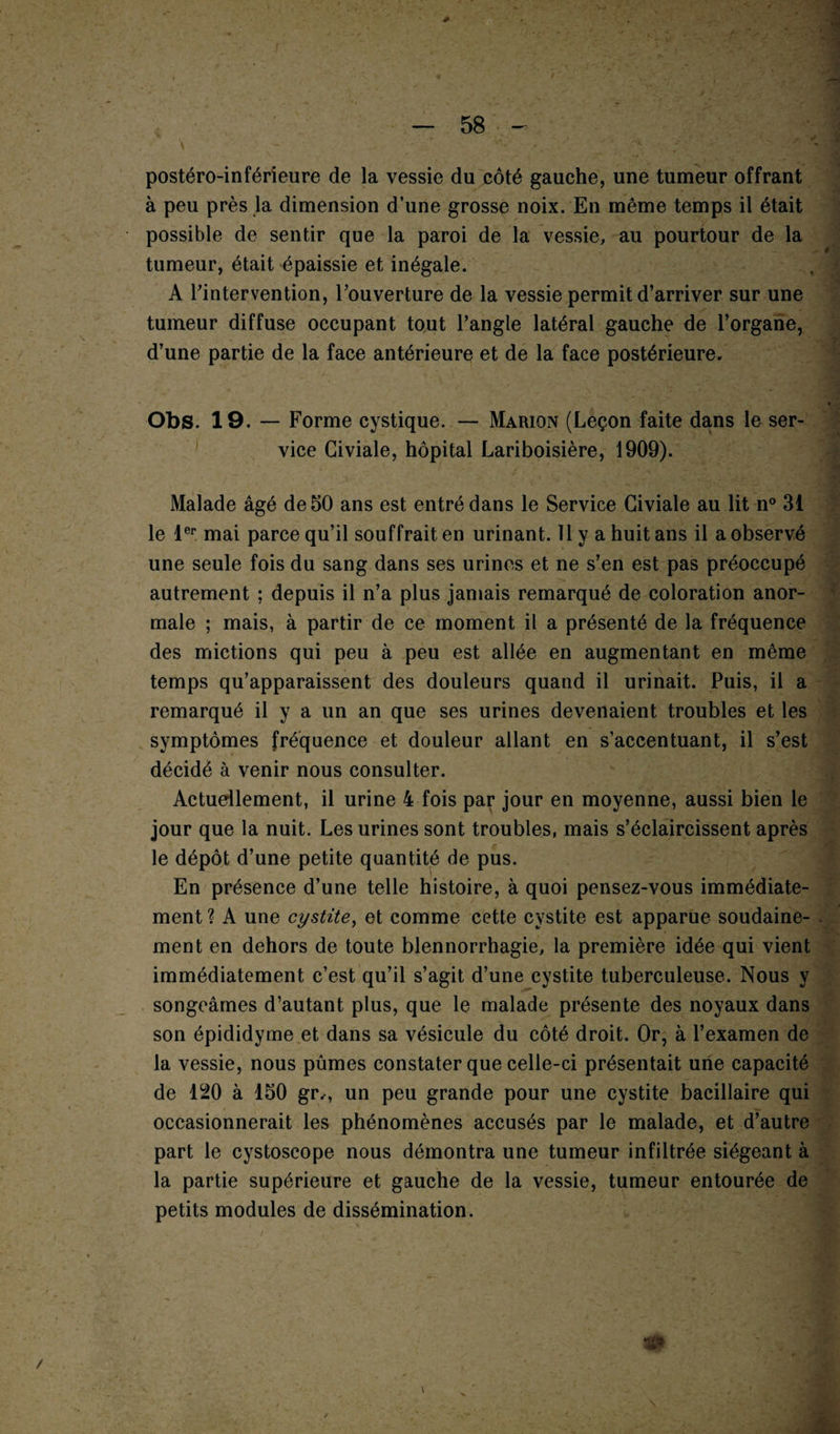 * 1 postéro-inférieure de la vessie du côté gauche, une tumeur offrant à peu près la dimension d’une grosse noix. En même temps il était possible de sentir que la paroi de la vessie, au pourtour de la tumeur, était épaissie et inégale. A Tintervention, l’ouverture de la vessie permit d’arriver sur une tumeur diffuse occupant tout l’angle latéral gauche de l’organe, d’une partie de la face antérieure et de la face postérieure. Obs. 19. — Forme cystique. — Marion (Leçon faite dans le ser¬ vice Giviale, hôpital Lariboisière, 1909). Malade âgé de 50 ans est entré dans le Service Giviale au lit n° 31 le 1er mai parce qu’il souffrait en urinant. 11 y a huit ans il a observé une seule fois du sang dans ses urines et ne s’en est pas préoccupé autrement ; depuis il n’a plus jamais remarqué de coloration anor¬ male ; mais, à partir de ce moment il a présenté de la fréquence des mictions qui peu à peu est allée en augmentant en même temps qu’apparaissent des douleurs quand il urinait. Puis, il a remarqué il y a un an que ses urines devenaient troubles et les symptômes fréquence et douleur allant en s’accentuant, il s’est décidé à venir nous consulter. Actuellement, il urine 4 fois par jour en moyenne, aussi bien le jour que la nuit. Les urines sont troubles, mais s’éclaircissent après le dépôt d’une petite quantité de pus. En présence d’une telle histoire, à quoi pensez-vous immédiate¬ ment ? A une cystite, et comme cette cystite est apparue soudaine¬ ment en dehors de toute blennorrhagie, la première idée qui vient immédiatement c’est qu’il s’agit d’une cystite tuberculeuse. Nous y songeâmes d’autant plus, que le malade présente des noyaux dans son épididyme et dans sa vésicule du côté droit. Or, à l’examen de la vessie, nous pûmes constater que celle-ci présentait une capacité de 120 à 150 gr., un peu grande pour une cystite bacillaire qui occasionnerait les phénomènes accusés par le malade, et d’autre part le cystoscope nous démontra une tumeur infiltrée siégeant à la partie supérieure et gauche de la vessie, tumeur entourée de petits modules de dissémination. \ / \