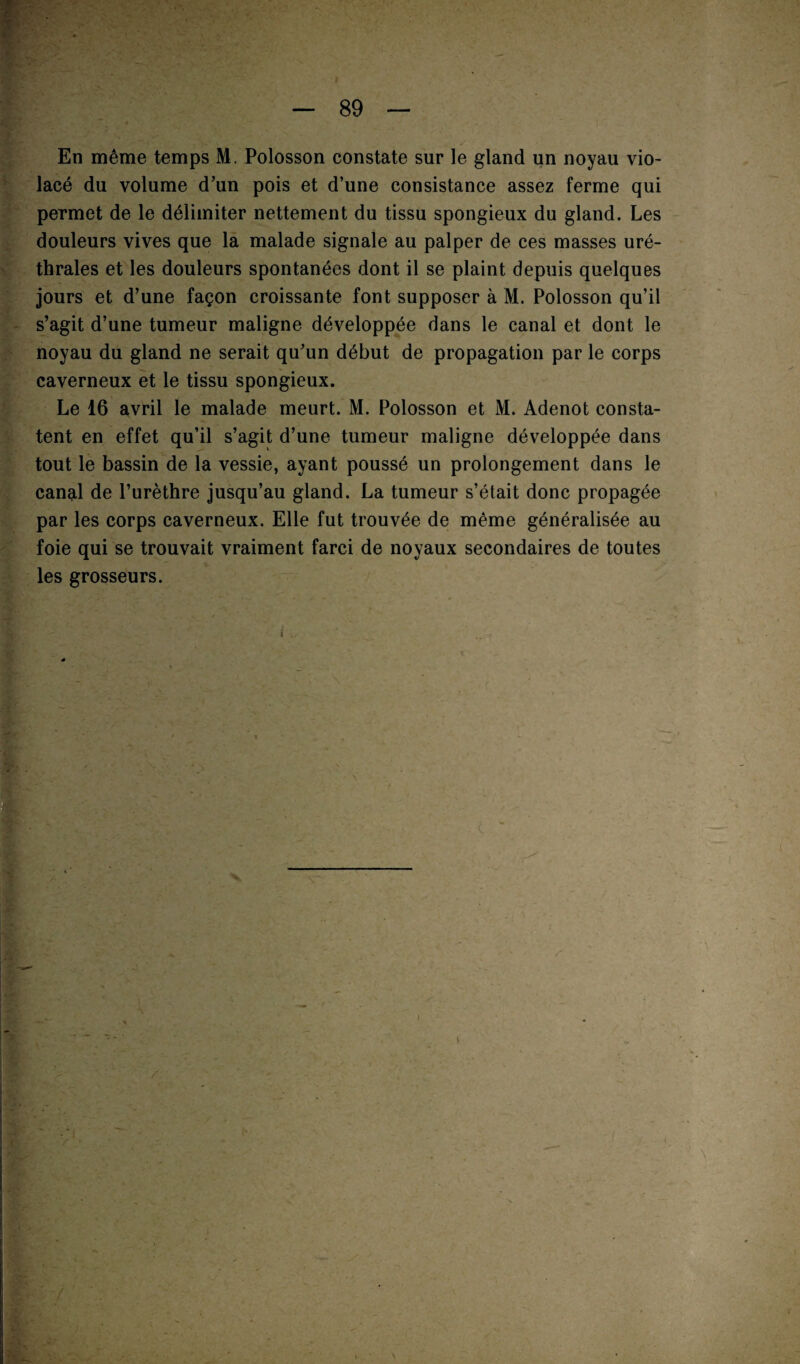 En même temps M. Polosson constate sur le gland un noyau vio¬ lacé du volume d’un pois et d’une consistance assez ferme qui permet de le délimiter nettement du tissu spongieux du gland. Les douleurs vives que la malade signale au palper de ces masses uré¬ thrales et les douleurs spontanées dont il se plaint depuis quelques jours et d’une façon croissante font supposer à M. Polosson qu’il s’agit d’une tumeur maligne développée dans le canal et dont le noyau du gland ne serait qu’un début de propagation par le corps caverneux et le tissu spongieux. Le 16 avril le malade meurt. M. Polosson et M. Adenot consta¬ tent en effet qu’il s’agit d’une tumeur maligne développée dans tout le bassin de la vessie, ayant poussé un prolongement dans le canal de l’urèthre jusqu’au gland. La tumeur s’était donc propagée par les corps caverneux. Elle fut trouvée de même généralisée au foie qui se trouvait vraiment farci de noyaux secondaires de toutes les grosseurs.