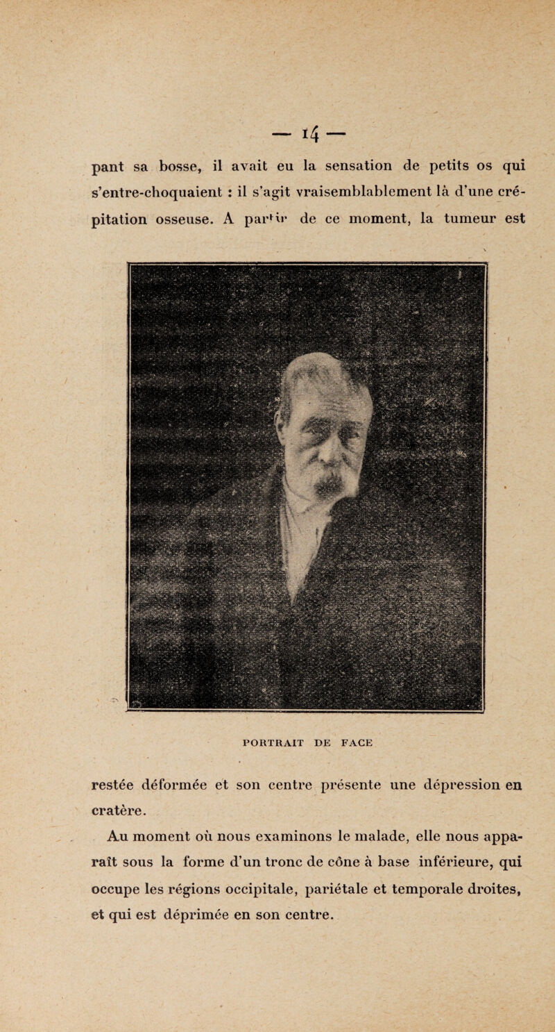 s’entre-choquaient : il s’agit vraisemblablement là d’une cré¬ pitation osseuse. A partir de ce moment, la tumeur est PORTRAIT DE FACE restée déformée et son centre présente une dépression en cratère. Au moment où nous examinons le malade, elle nous appa¬ raît sous la forme d’un tronc de cône à base inférieure, qui occupe les régions occipitale, pariétale et temporale droites, et qui est déprimée en son centre.