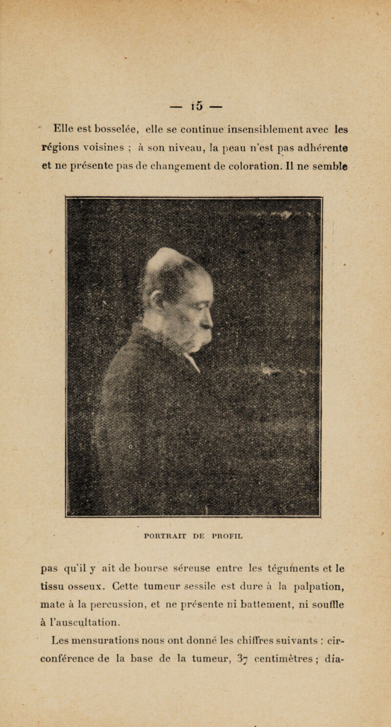 Elle est bosselée, elle se continue insensiblement avec les régions voisines ; à son niveau, la peau n’est pas adhérente t « et ne présente pas de changement de coloration. Il ne semble PORTRAIT DE PROFIL pas qu’il y ait de bourse séreuse entre les téguments et le tissu osseux. Cette tumeur sessile est dure à la palpation, mate à la percussion, et ne présente ni battement, ni souille à l’auscultation. Les mensurations nous ont donné les chiffres suivants : cir¬ conférence de la base de la tumeur, centimètres ; dia-