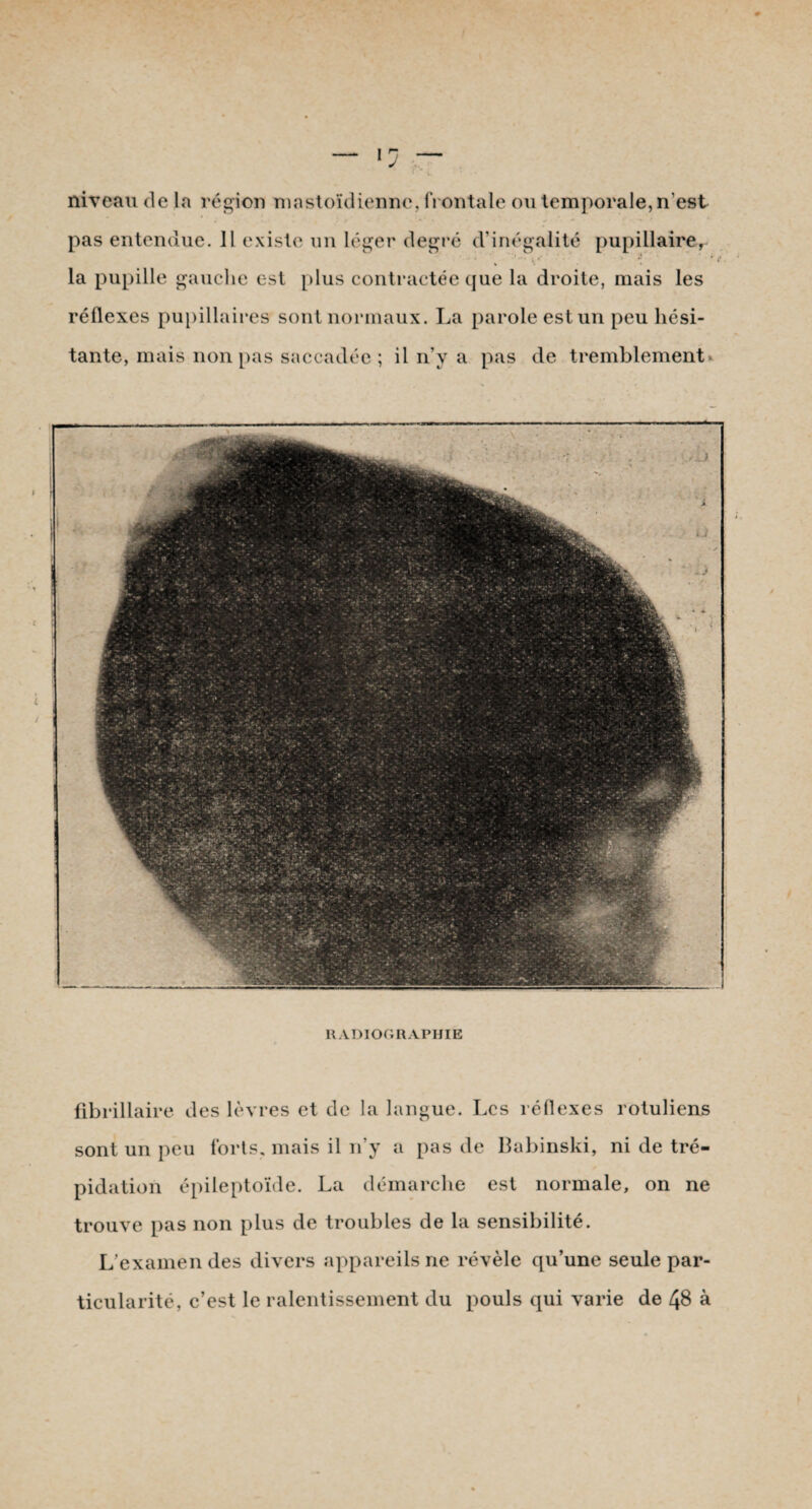niveau de la région mastoïdienne,frontale ou temporale, n'est pas entendue. 11 existe un léger degré d’inégalité pupillaire, la pupille gauche est plus contractée que la droite, mais les réflexes pupillaires sont normaux. La parole est un peu hési¬ tante, mais non pas saccadée ; il n’y a pas de tremblement RADIOGRAPHIE fibrillaire des lèvres et de la langue. Les réflexes rotuliens sont un peu forts, mais il n’y a pas de Babinski, ni de tré¬ pidation épileptoïde. La démarche est normale, on ne trouve pas non plus de troubles de la sensibilité. L’examen des divers appareils ne révèle qu’une seule par¬ ticularité, c’est le ralentissement du pouls qui varie de 48 à