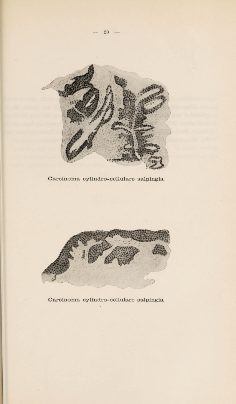 Carcinoma cylindro-cellulare salpingis.