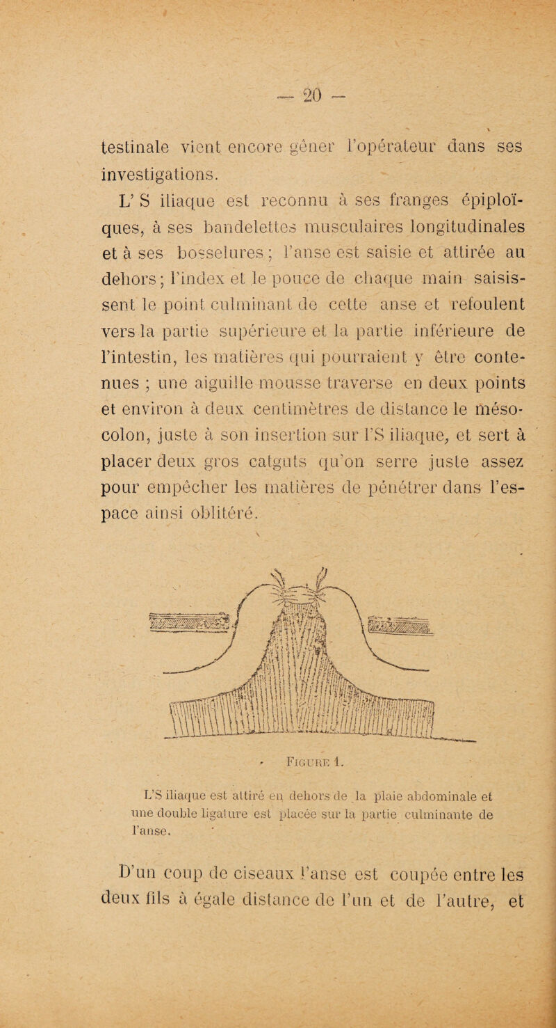 testinale vient encore gêner l’opérateur dans ses investigations. L’ S iliaque est reconnu à ses franges épiploï¬ ques, à ses bandelettes musculaires longitudinales et à ses bosselures ; l’anse est saisie et attirée au dehors; l’index et le pouce de chaque main saisis¬ sent le point culminant de cette anse et refoulent vers la partie supérieure et la partie inférieure de l’intestin, les matières qui pourraient y être conte¬ nues ; une aiguille mousse traverse en deux points et environ à deux centimètres de distance le méso¬ colon, juste à son insertion sur l’S iliaque, et sert à placer deux gros catguts qu’on serre juste assez pour empêcher les matières de pénétrer dans l’es¬ pace ainsi oblitéré. L’S iliaque est attiré en dehors de la plaie abdominale et une double ligature est placée sur la partie culminante de l’anse. D’un coup de ciseaux l’anse est coupée entre les deux fils à égale distance de l’un et de l’autre, et