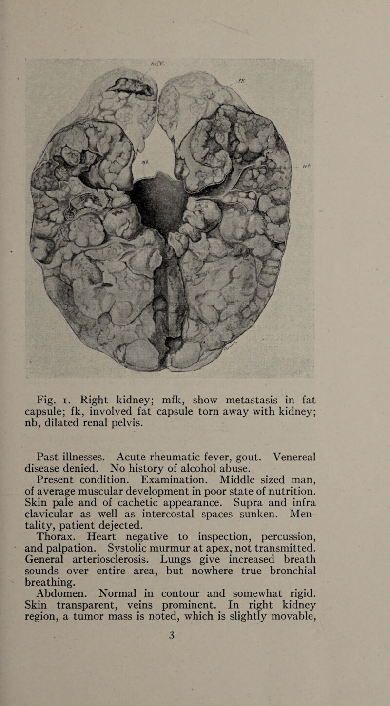 «A Fig. i. Right kidney; mfk, show metastasis in fat capsule; fk, involved fat capsule torn away with kidney; nb, dilated renal pelvis. Past illnesses. Acute rheumatic fever, gout. Venereal disease denied. No history of alcohol abuse. Present condition. Examination. Middle sized man, of average muscular development in poor state of nutrition. Skin pale and of cachetic appearance. Supra and infra clavicular as well as intercostal spaces sunken. Men¬ tality, patient dejected. Thorax. Heart negative to inspection, percussion, and palpation. Systolic murmur at apex, not transmitted. General arteriosclerosis. Lungs give increased breath sounds over entire area, but nowhere true bronchial breathing. Abdomen. Normal in contour and somewhat rigid. Skin transparent, veins prominent. In right kidney region, a tumor mass is noted, which is slightly movable,