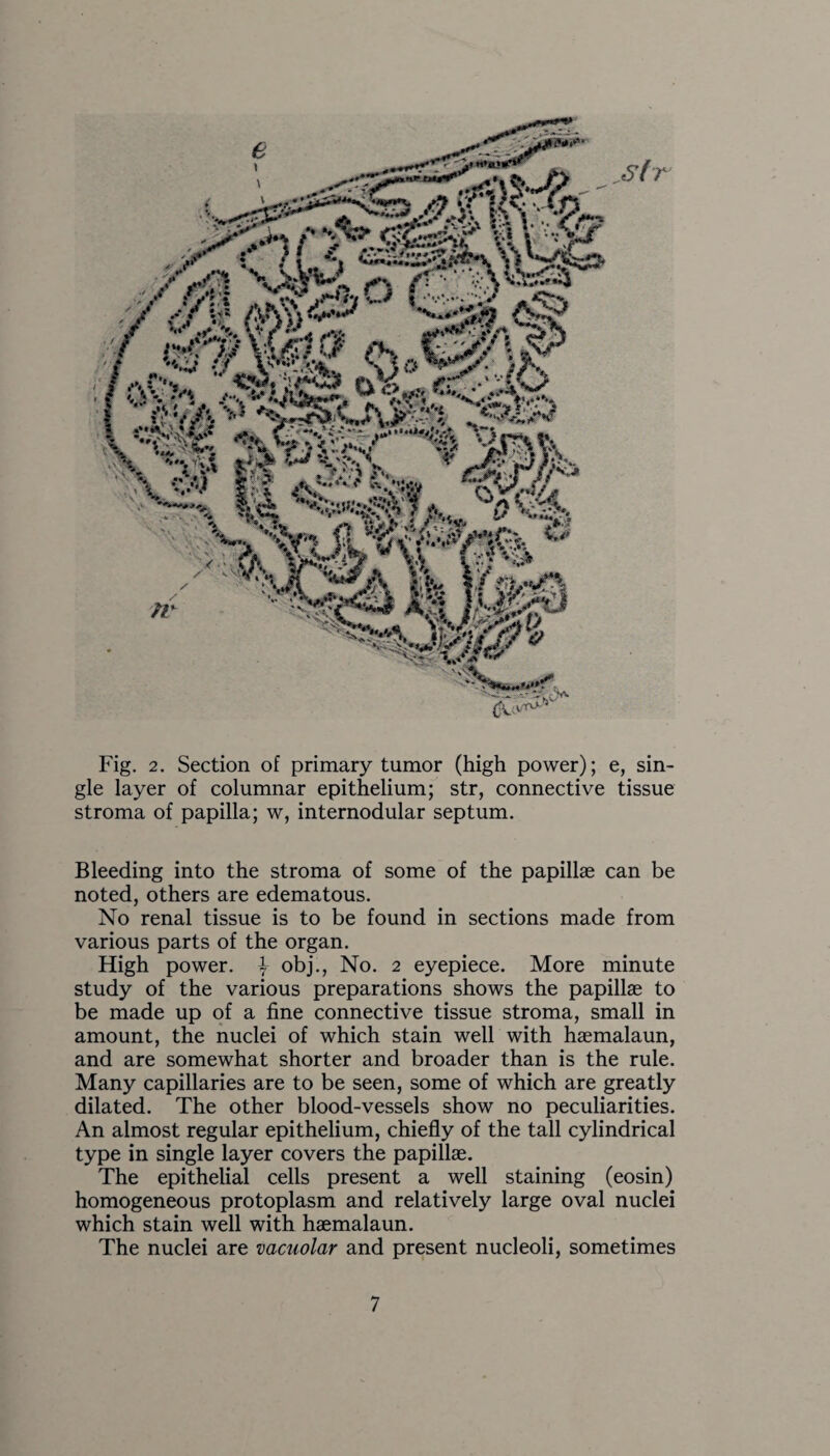 Sf r Fig. 2. Section of primary tumor (high power); e, sin¬ gle layer of columnar epithelium; str, connective tissue stroma of papilla; w, internodular septum. Bleeding into the stroma of some of the papillae can be noted, others are edematous. No renal tissue is to be found in sections made from various parts of the organ. High power. \ obj., No. 2 eyepiece. More minute study of the various preparations shows the papillae to be made up of a fine connective tissue stroma, small in amount, the nuclei of which stain well with haemalaun, and are somewhat shorter and broader than is the rule. Many capillaries are to be seen, some of which are greatly dilated. The other blood-vessels show no peculiarities. An almost regular epithelium, chiefly of the tall cylindrical type in single layer covers the papillae. The epithelial cells present a well staining (eosin) homogeneous protoplasm and relatively large oval nuclei which stain well with haemalaun. The nuclei are vacuolar and present nucleoli, sometimes