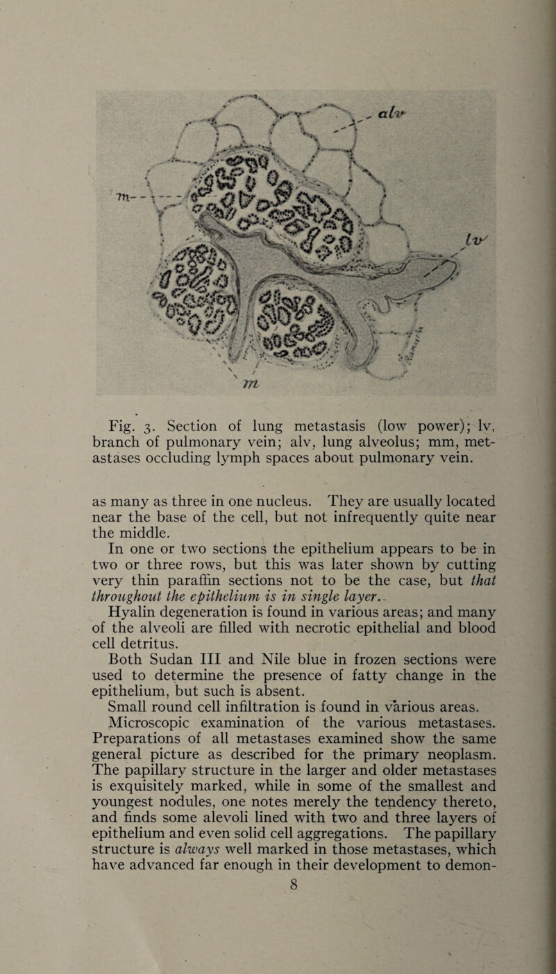 Fig. 3. Section of lung metastasis (low power); lv, branch of pulmonary vein; alv, lung alveolus; mm, met- astases occluding lymph spaces about pulmonary vein. as many as three in one nucleus. They are usually located near the base of the cell, but not infrequently quite near the middle. In one or two sections the epithelium appears to be in two or three rows, but this was later shown by cutting very thin paraffin sections not to be the case, but that throughout the epithelium is in single layer.. Hyalin degeneration is found in various areas; and many of the alveoli are filled with necrotic epithelial and blood cell detritus. Both Sudan III and Nile blue in frozen sections were used to determine the presence of fatty change in the epithelium, but such is absent. Small round cell infiltration is found in various areas. Microscopic examination of the various metastases. Preparations of all metastases examined show the same general picture as described for the primary neoplasm. The papillary structure in the larger and older metastases is exquisitely marked, while in some of the smallest and youngest nodules, one notes merely the tendency thereto, and finds some alevoli lined with two and three layers of epithelium and even solid cell aggregations. The papillary structure is always well marked in those metastases, which have advanced far enough in their development to demon-