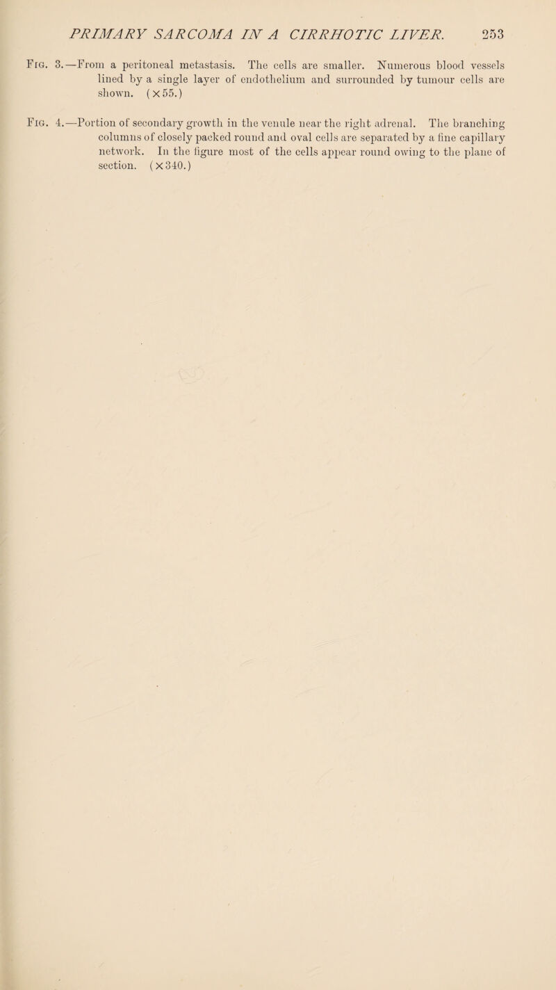 3. —From a peritoneal metastasis. The cells are smaller. Numerous blood vessels lined by a single layer of endothelium and surrounded by tumour cells are shown. (x55.) 4. —Portion of secondary growth in the venule near the right adrenal. The branching columns of closely packed round and oval cells are separated by a fine capillary network. In the figure most of the cells appear round owing to the plane of section. (X340.)