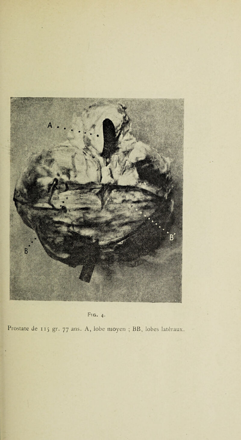 Prostate de 115 gr. 77 ans. A, lobe moyen BB, lobes latéraux.