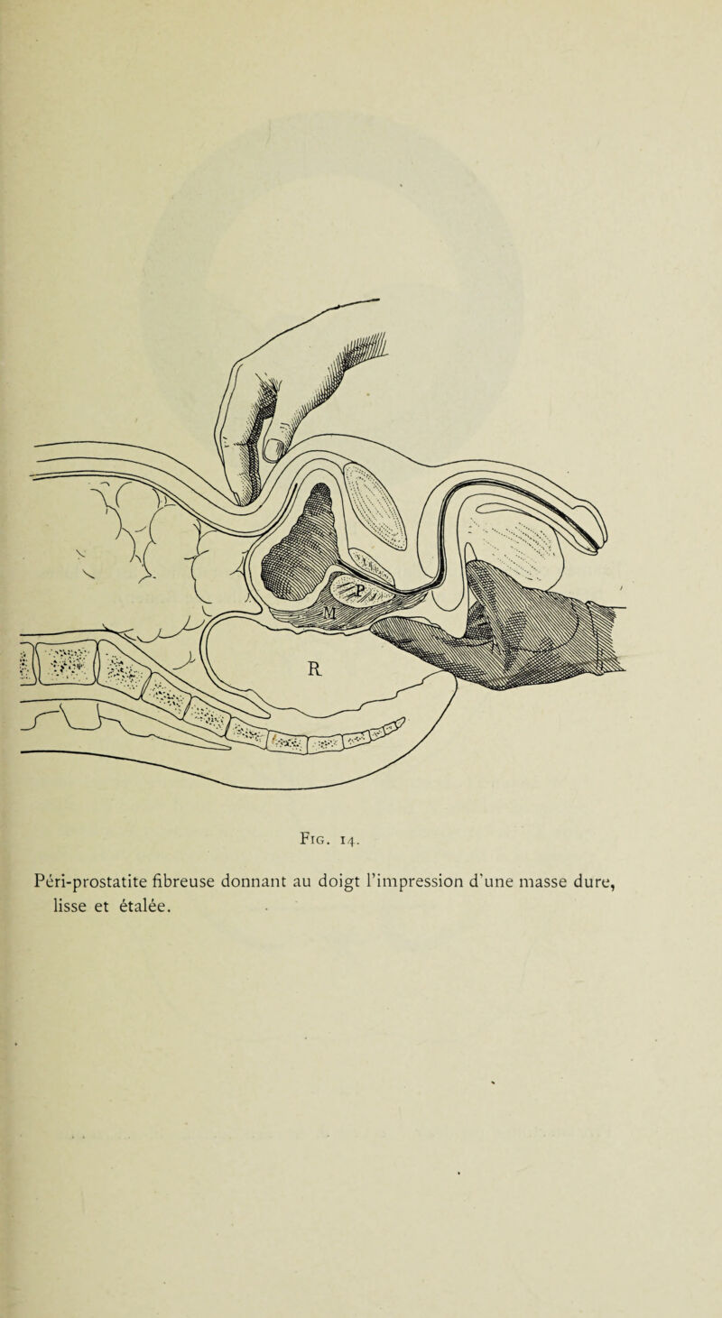 Péri-prostatite fibreuse donnant au doigt l’impression d'une masse dure, lisse et étalée.