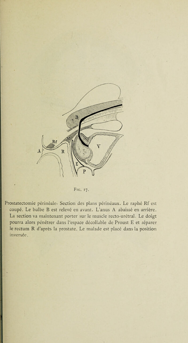 ■ Prostatectomie périnéale* Section des plans périnéaux. Le raphé Rf est coupé. Le bulbe B est relevé en avant. L'anus A abaissé en arrière. La section va maintenant porter sur le muscle recto-urétral. Le doigt pourra alors pénétrer dans Pespace décollable de Proust E et séparer le rectum R d’après la prostate. Le malade est placé dans la position inversée. I