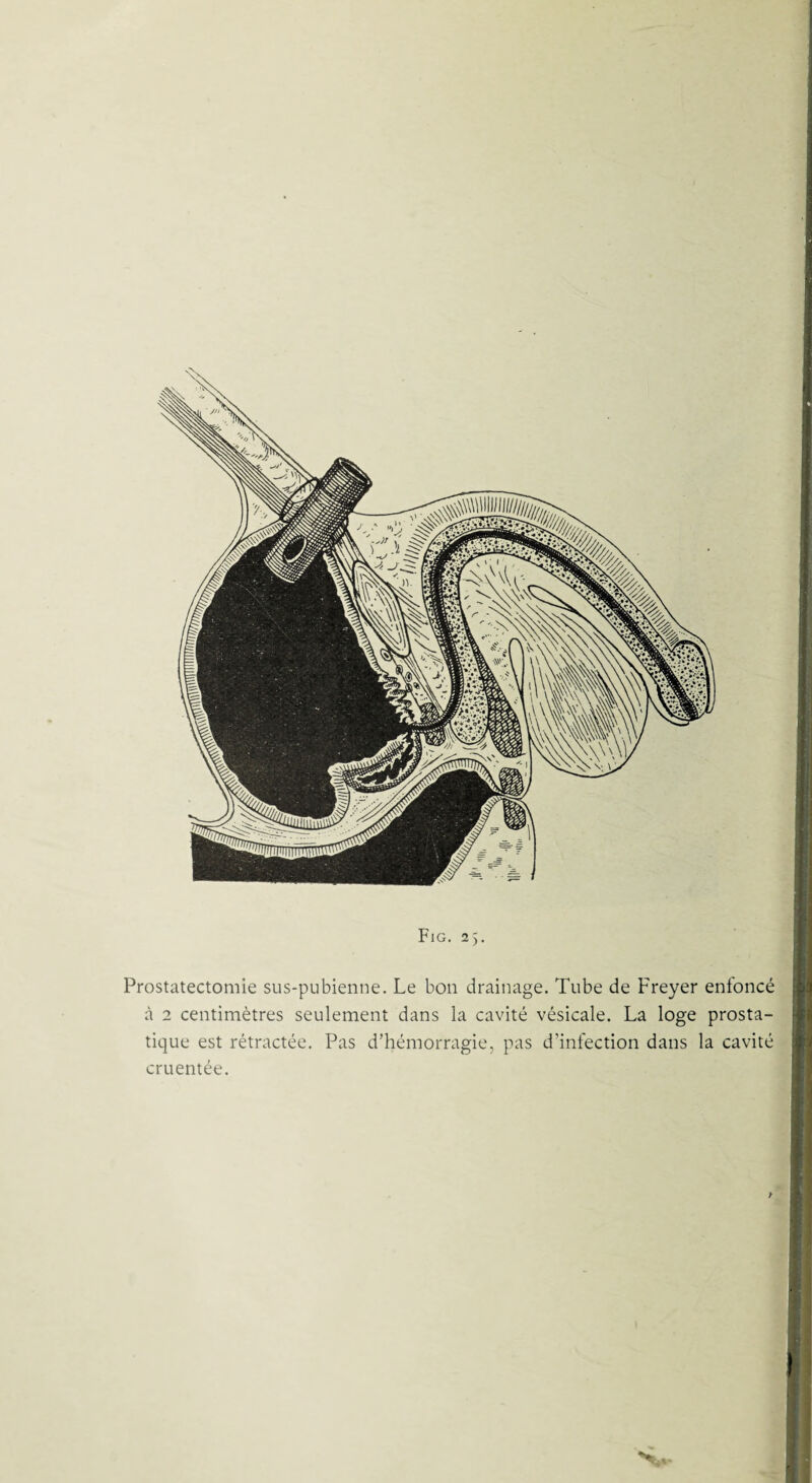 Prostatectomie sus-pubienne. Le bon drainage. Tube de Freyer enfoncé à 2 centimètres seulement dans la cavité vésicale. La loge prosta¬ tique est rétractée. Pas d’hémorragie, pas d’infection dans la cavité cruentée. /